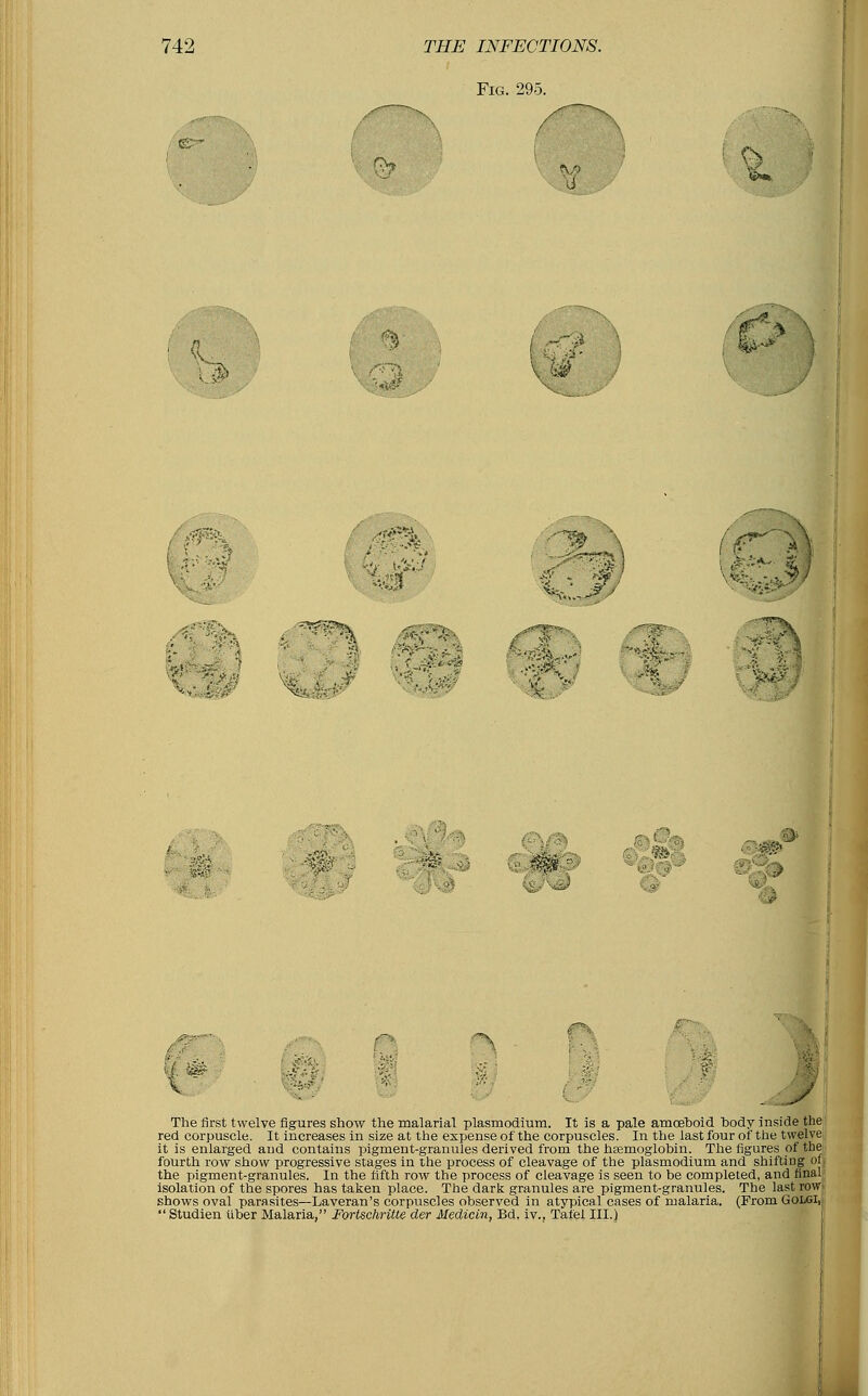 Fig. 295. h y The first twelve figures show the malarial Plasmodium. It is a pale amoeboid body inside the red corpuscle. It increases in size at the expense of the corpuscles. In the last four of the twelve it is enlarged and contains pigment-granules derived from the hEernoglobin. The figures of the fourth row show progressive stages in the process of cleavage of the Plasmodium and shifi the pigment-granules. In the fifth row the process of cleavage is seen to be completed, and final isolation of the spores has taken place. The dark granules are pigment-granules. The last row shows oval parasites—Laveran's corpuscles observed in atypical cases of malaria. (From Golgi, Studien liber Malaria, Forlschritte der Medicin, Bd. iv., Tafel III.)