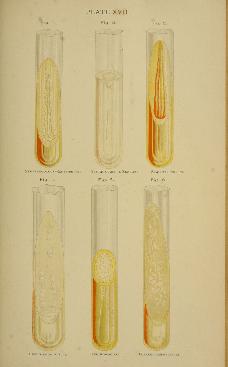 PLATE XVII. rbcoccus—Erysipelas. Streptococcus Septicui Fig. 4. Fig. 5. %- Typhoid-bacu