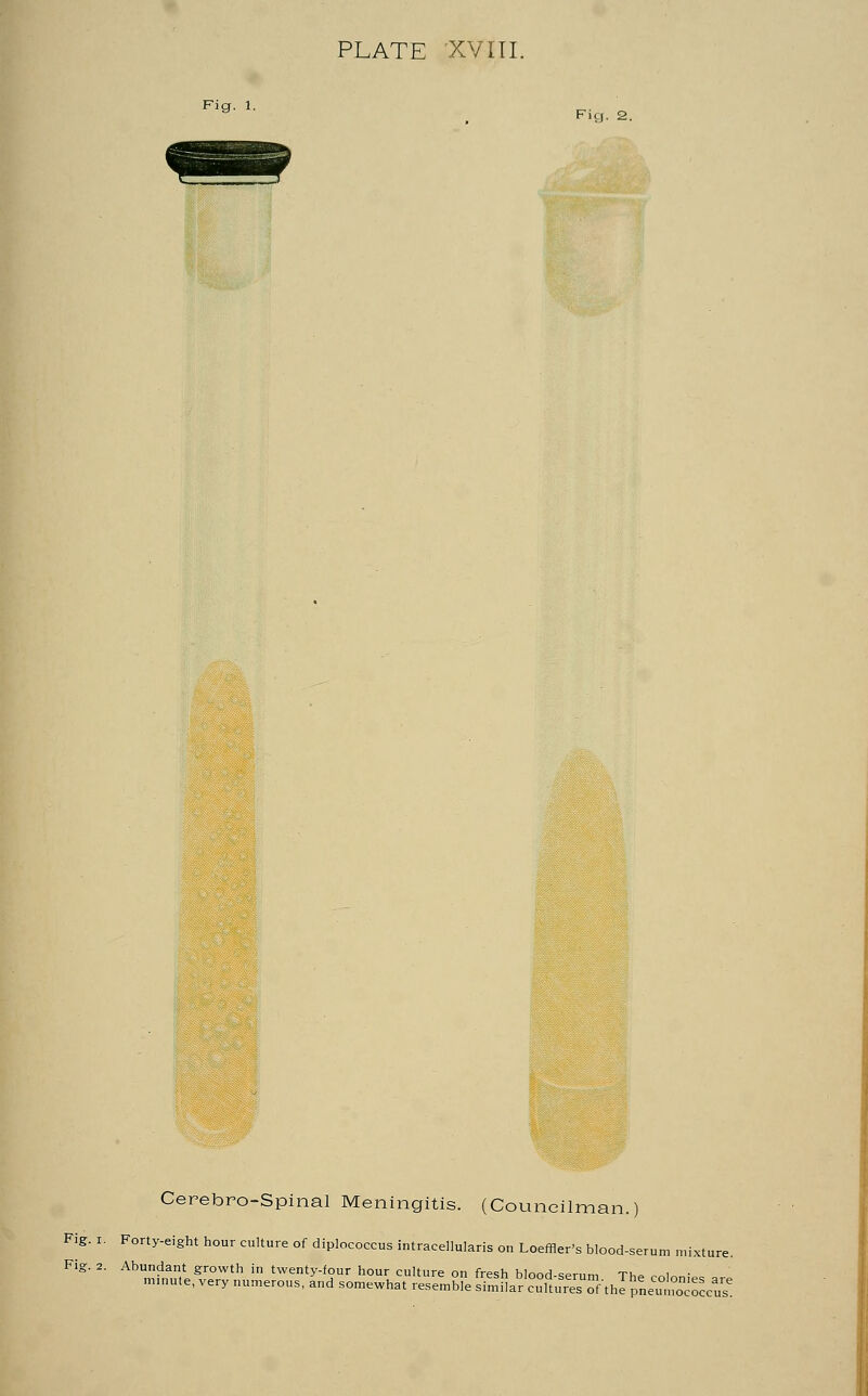 PLATE XVIII. Cerebro-Spinal Meningitis. (Councilman. Fig. i. Forty-eight hour culture of diplococcus intracellulai Fig. 2. Abundant growth ir u Loeffler's blood-s twenty-four hour culture on fresh blood-serum The colonies ar irous, and somewhat resemble similar cultures of the pneumococcal