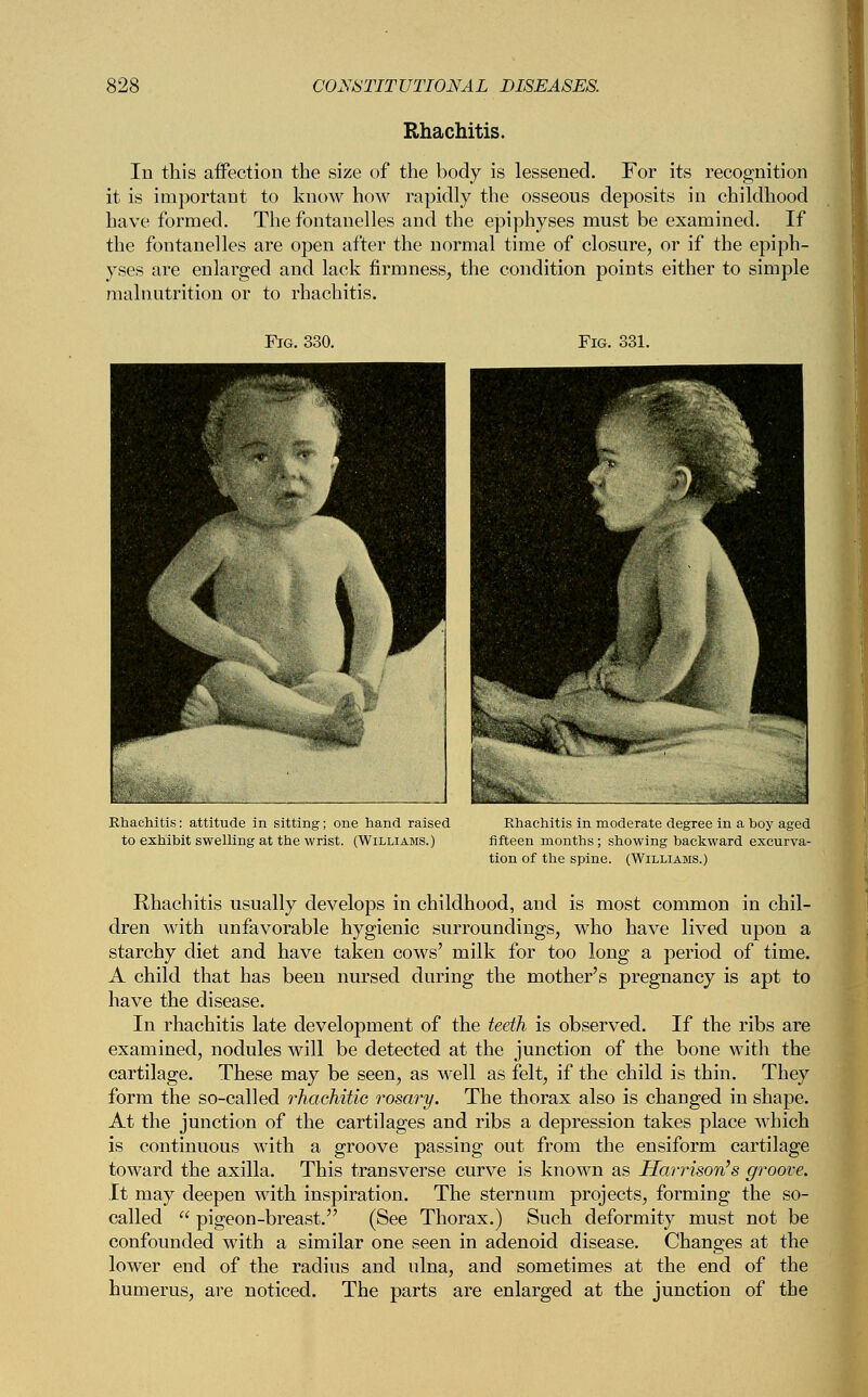 Rhachitis. In this affection the size of the body is lessened. For its recognition it is important to know how rapidly the osseous deposits in childhood have formed. The fontanelles and the epiphyses must be examined. If the fontanelles are open after the normal time of closure, or if the epiph- yses are enlarged and lack firmness, the condition points either to simple malnutrition or to rhachitis. Rhachitis: attitude in sitting; one hand raised to exhibit swelling at the wrist. (Williams.) Rhachitis in moderate degree in a boy aged fifteen months; showing backward excurva- tion of the spine. (Williams.) Rhachitis usually develops in childhood, and is most common in chil- dren with unfavorable hygienic surroundings, who have lived upon a starchy diet and have taken cows' milk for too long a period of time. A child that has been nursed during the mother's pregnancy is apt to have the disease. In rhachitis late development of the teeth is observed. If the ribs are examined, nodules will be detected at the junction of the bone with the cartilage. These may be seen, as well as felt, if the child is thin. They form the so-called rhachitic rosary. The thorax also is changed in shape. At the junction of the cartilages and ribs a depression takes place which is continuous with a groove passing out from the ensiform cartilage toward the axilla. This transverse curve is known as Harrison's groove. It may deepen with inspiration. The sternum projects, forming the so- called  pigeon-breast. (See Thorax.) Such deformity must not be confounded with a similar one seen in adenoid disease. Changes at the lower end of the radius and ulna, and sometimes at the end of the humerus, are noticed. The parts are enlarged at the junction of the