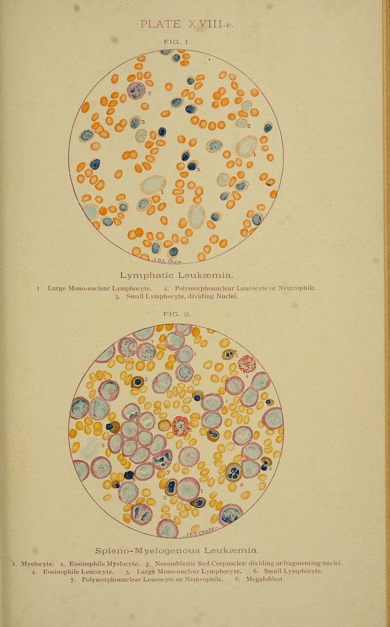 Lymphatie Leukaemia. Large Mono-nuclear Lymphocyte. 2. Polymorphonuclear Leucocyte or NeuU'ophile. 3. Small Lymphocyte, dividing Nuclei. Spleno-Myelogenous Leukaemia. Myelocyte. 2. Eosinophile Myelocyte. 3. Normoblastic Red Corpuscles: dividing or fragmenting n 4. Eosinophile Leucocyte. 5. Large Mono-nuclear Lymphocyte. 6. Small Lymphocyte. 7. Polymorphonuclear Leucocyte or Neutrophile. 8. Megaloblast.