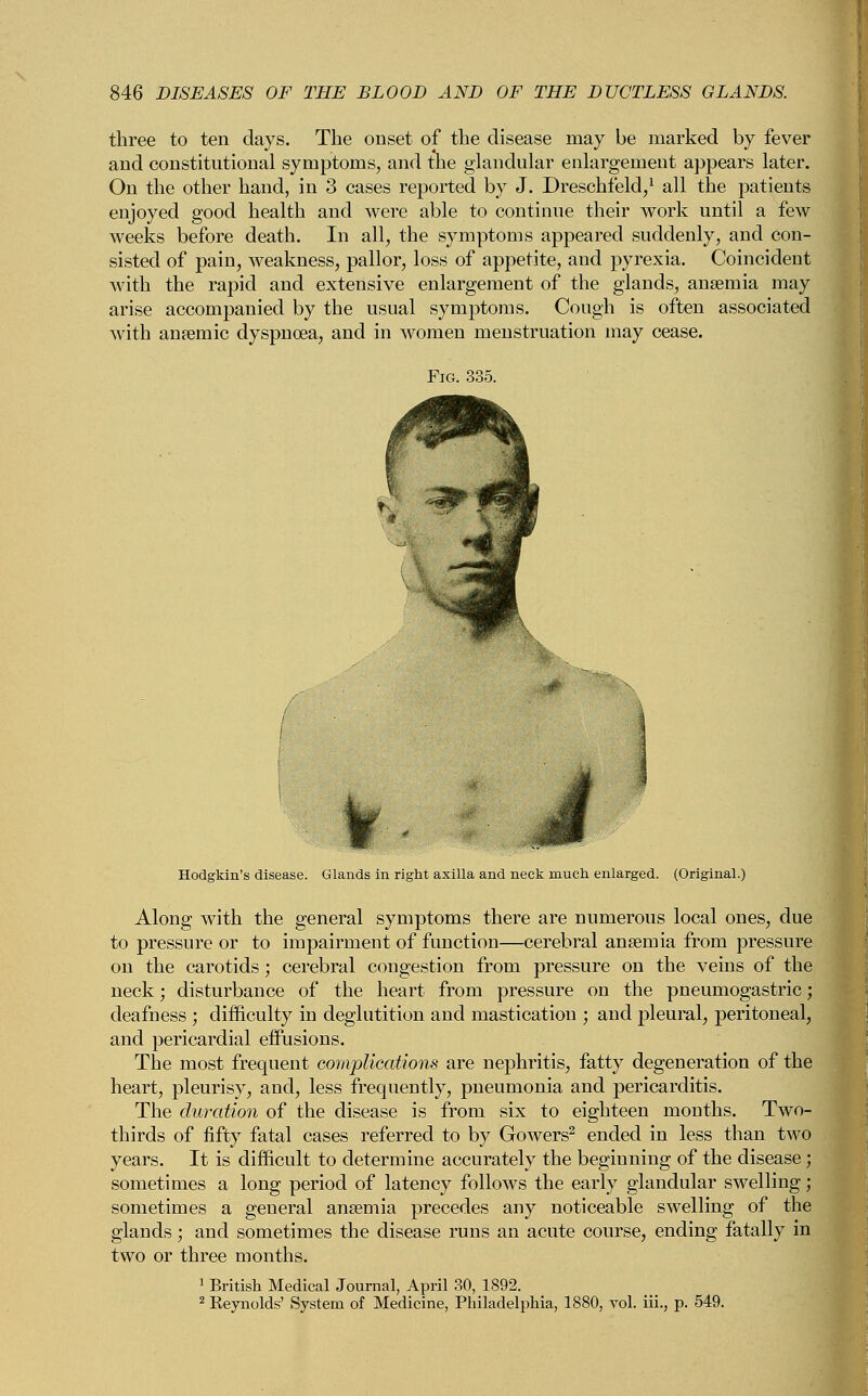 three to ten days. The onset of the disease may be marked by fever and constitutional symptoms, and the glandular enlargement appears later. On the other hand, in 3 cases reported by J. Dreschfeld,1 all the patients enjoyed good health and were able to continue their work until a few weeks before death. In all, the symptoms appeared suddenly, and con- sisted of pain, weakness, pallor, loss of appetite, and pyrexia. Coincident with the rapid and extensive enlargement of the glands, anaemia may arise accompanied by the usual symptoms. Cough is often associated with anaemic dyspnoea, and in women menstruation may cease. Hodgkin's disease. Glands in right axilla and neck much enlarged. (Original.) Along with the general symptoms there are numerous local ones, due to pressure or to impairment of function—cerebral anaemia from pressure on the carotids; cerebral congestion from pressure on the veins of the neck; disturbance of the heart from pressure on the pneumogastric; deafness ; difficulty in deglutition and mastication ; and pleural, peritoneal, and pericardial effusions. The most frequent complications are nephritis, fatty degeneration of the heart, pleurisy, and, less frequently, pneumonia and pericarditis. The duration of the disease is from six to eighteen months. Two- thirds of fifty fatal cases referred to by Gowers2 ended in less than two years. It is difficult to determine accurately the beginning of the disease; sometimes a long period of latency follows the early glandular swelling; sometimes a general anaemia precedes any noticeable swelling of the glands; and sometimes the disease runs an acute course, ending fatally in two or three months. 1 British Medical Journal, April 30, 1892. 2 KeynoldV System of Medicine, Philadelphia, 1880, vol. iii., p. 549.