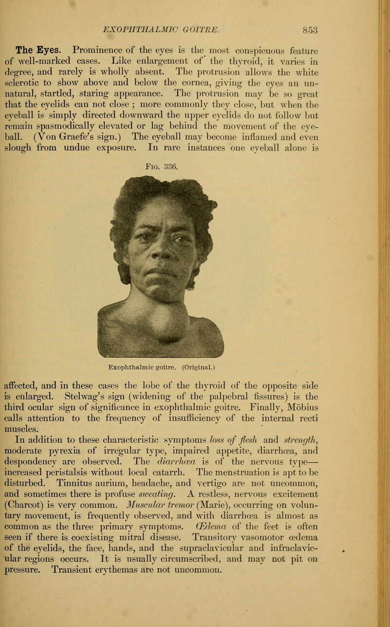 The Eyes. Prominence of the eyes is the most conspicuous feature of well-marked cases. Like enlargement of the thyroid, it varies in degree, and rarely is wholly absent. The protrusion allows the white sclerotic to show above and below the cornea, giving the eyes an un- natural, startled, staring appearance. The protrusion may be so great that the eyelids can not close ; more commonly they close, but when the eyeball is simply directed downward the upper eyelids do not follow but remain spasmodically elevated or lag behind the movement of the eye- ball. (Yon Graefe's sign.) The eyeball may become inflamed and even slough from undue exposure. In rare instances one eyeball alone is Exophthalmic goitre. (Original.) affected, and in these cases the lobe of the thyroid of the opposite side is enlarged. Stelwag's sign (widening of the palpebral fissures) is the third ocular sign of significance in exophthalmic goitre. Finally, Mobius calls attention to the frequency of insufficiency of the internal recti muscles. In addition to these characteristic symptoms loss of flesh and strength, moderate pyrexia of irregular type, impaired appetite, diarrhoea, and despondency are observed. The diarrhoea is of the nervous type— increased peristalsis without local catarrh. The menstruation is apt to be disturbed. Tinnitus aurium, headache, and vertigo are not uncommon, and sometimes there is profuse sweating. A restless, nervous excitement (Charcot) is very common. Muscular tremor (Marie), occurring on volun- tary movement, is frequently observed, and with diarrhoea is almost as common as the three primary symptoms. (Edema of the feet is often seen if there is coexisting mitral disease. Transitory vasomotor oedema of the eyelids, the face, hands, and the supraclavicular and infraclavic- ular regions occurs. It is usually circumscribed, and may not pit on pressure. Transient erythemas are not uncommon.