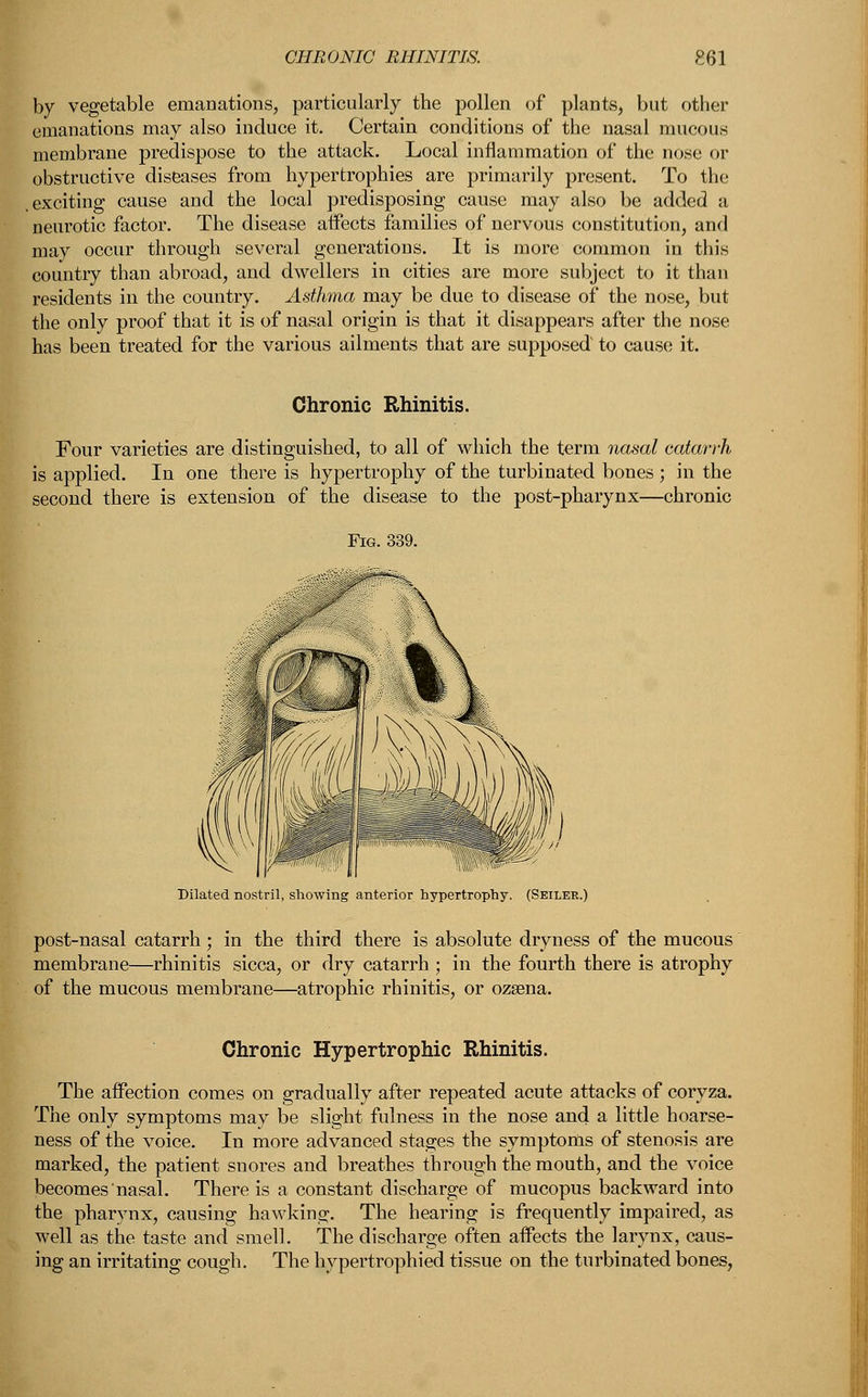 by vegetable emanations, particularly the pollen of plants, but other emanations may also induce it. Certain conditions of the nasal mucous membrane predispose to the attack. Local inflammation of the nose or obstructive diseases from hypertrophies are primarily present. To the .exciting cause and the local predisposing cause may also be added a neurotic factor. The disease atfects families of nervous constitution, and may occur through several generations. It is more common in this country than abroad, and dwellers in cities are more subject to it than residents in the country. Asthma may be due to disease of the nose, but the only proof that it is of nasal origin is that it disappears after the nose has been treated for the various ailments that are supposed to cause it. Chronic Rhinitis. Four varieties are distinguished, to all of which the term nasal catarrh is applied. In one there is hypertrophy of the turbinated bones ; in the second there is extension of the disease to the post-pharynx—chronic Dilated nostril, showing anterior hypertrophy. (Seiler.) post-nasal catarrh; in the third there is absolute dryness of the mucous membrane—rhinitis sicca, or dry catarrh ; in the fourth there is atrophy of the mucous membrane—atrophic rhinitis, or ozeena. Chronic Hypertrophic Rhinitis. The affection comes on gradually after repeated acute attacks of coryza. The only symptoms may be slight fulness in the nose and a little hoarse- ness of the voice. In more advanced stages the symptoms of stenosis are marked, the patient snores and breathes through the mouth, and the voice becomes nasal. There is a constant discharge of mucopus backward into the pharynx, causing hawking. The hearing is frequently impaired, as well as the taste and smell. The discharge often affects the larynx, caus- ing an irritating cough. The hypertrophied tissue on the turbinated bones,