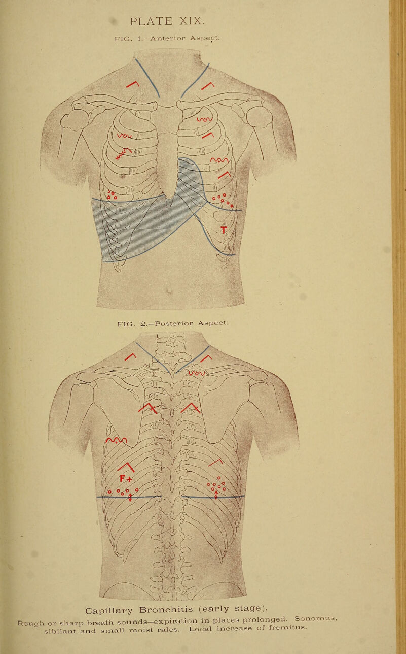 FIG. 1. —Anterior Aspect. FIG. 2.—Posterior Aspect. r^'t (T9%^ K//V Capillary Bronchitis (early stage). Rough or sharp breath sounds-expiration in places prolonged. Sonorc sibilant and small moist rales. Local increase of fremitus.