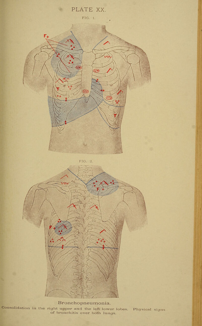 Bronchopneumonia. Consolidation in the right upper and the left lower lobes. Physical of bronchitis over both lungs.