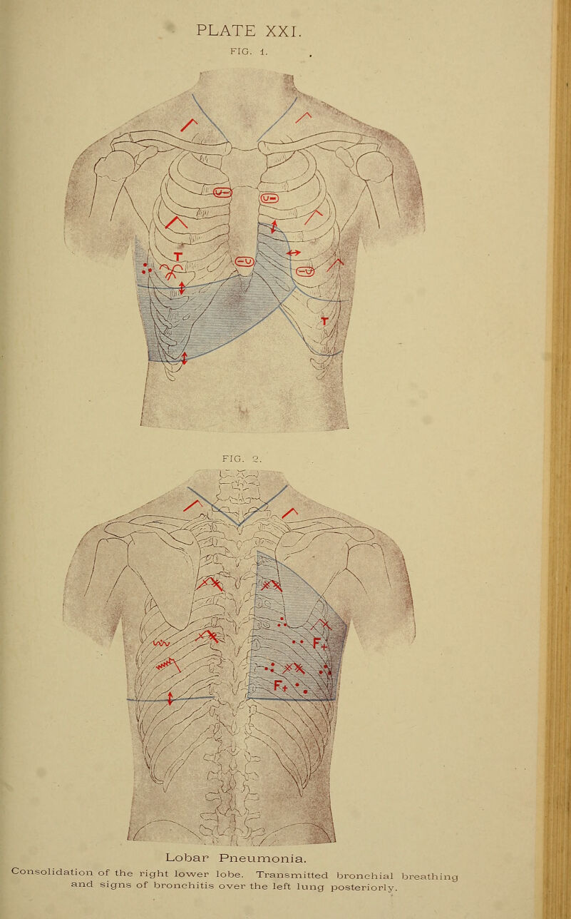 /vsCuiTi y /^_ / \ HI v Lobar Pneumonia. Consolidation of the right lower lobe. Transmitted bronchial breathing and signs of bronchitis over the left lung posteriorly.