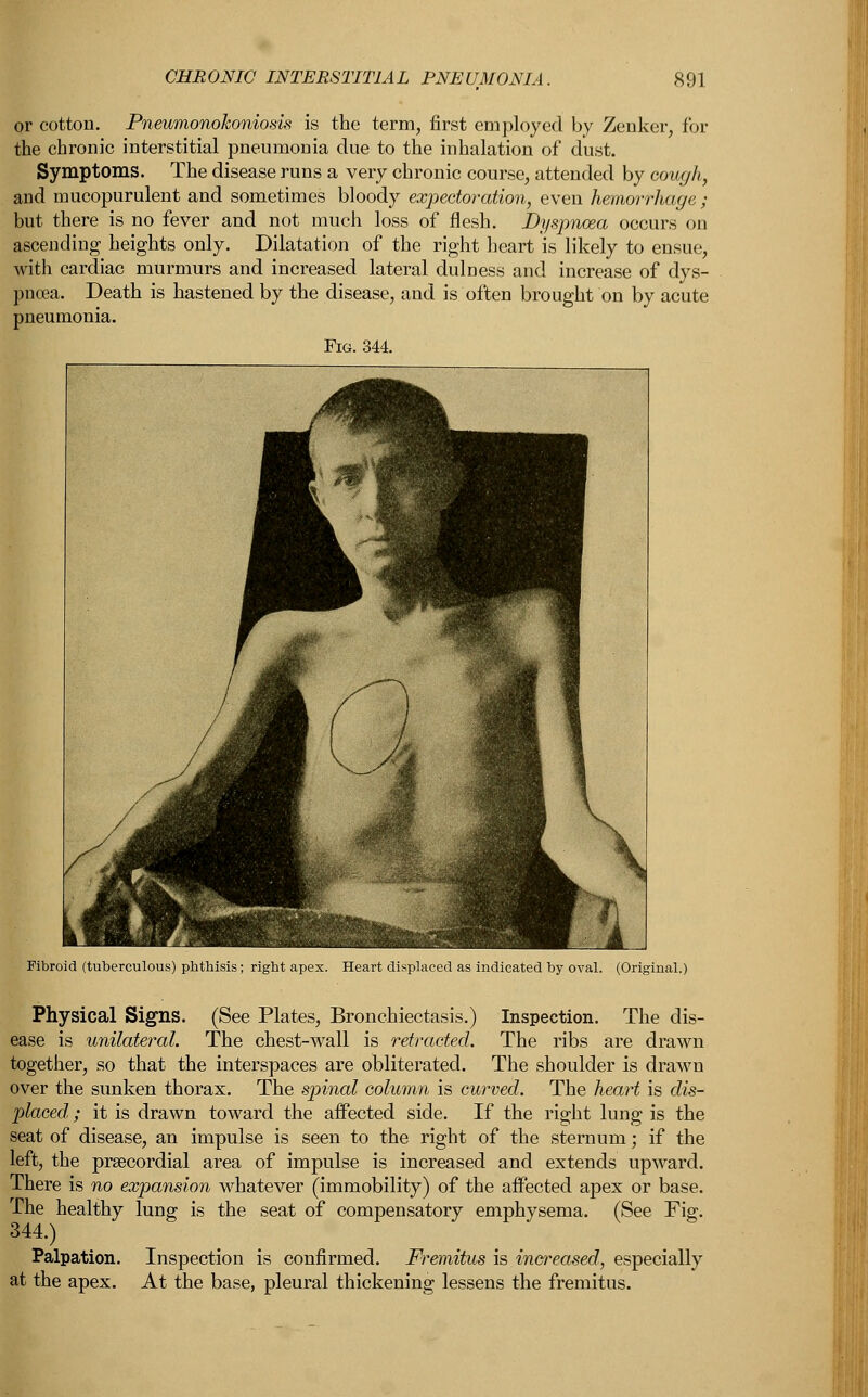 or cotton. Pneumonokoniosis is the term, first employed by Zenker, for the chronic interstitial pneumonia due to the inhalation of dust. Symptoms. The disease runs a very chronic course, attended by cough, and mucopurulent and sometimes bloody expectoration, even hemorrhage; but there is no fever and not much loss of flesh. Dyspnoea occurs on ascending heights only. Dilatation of the right heart is likely to ensue, with cardiac murmurs and increased lateral dulness and increase of dys- pnoea. Death is hastened by the disease, and is often brought on by acute pneumonia. Fig. 344. Fibroid (tuberculous) phthisis; right apex. Heart displaced as indicated by oval. (Original.) Physical Signs. (See Plates, Bronchiectasis.) Inspection. The dis- ease is unilateral. The chest-wall is retracted. The ribs are drawn together, so that the interspaces are obliterated. The shoulder is drawn over the sunken thorax. The spinal column is curved. The heart is dis- placed ; it is drawn toward the affected side. If the right lung is the seat of disease, an impulse is seen to the right of the sternum; if the left, the precordial area of impulse is increased and extends upward. There is no expansion whatever (immobility) of the affected apex or base. The healthy lung is the seat of compensatory emphysema. (See Fig. 344.) Palpation. Inspection is confirmed. Fremitus is increased, especially at the apex. At the base, pleural thickening lessens the fremitus.