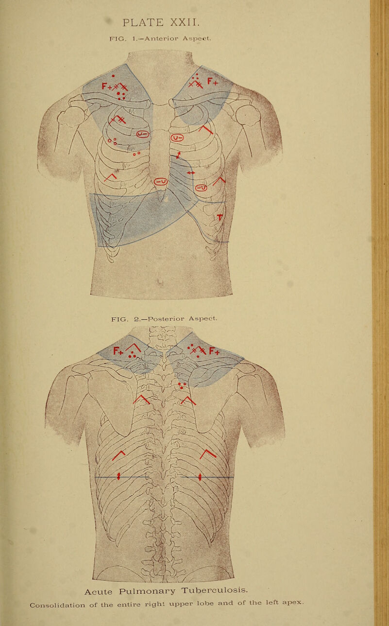 FIG. 1. —Anterior Aspect. r+X\ 1 / / \f >rk f+ KC ■T->v V FIG. 2.—Posterior Aspee Acute Pulmonary Tuberculosis. Consolidation of the entire right upper lobe and of the left apex.