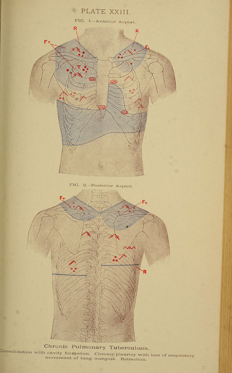 PLATE XXin. FIO. 1. —Anterior Aspec K •>& \ < FIO. 2.—Po Jte U ^s» Chronic Pulmonary Tuberculosis. Consolidation with cavity formation. Chronic pleurisy with loss of respiratory movement of lung margins. Retraction.