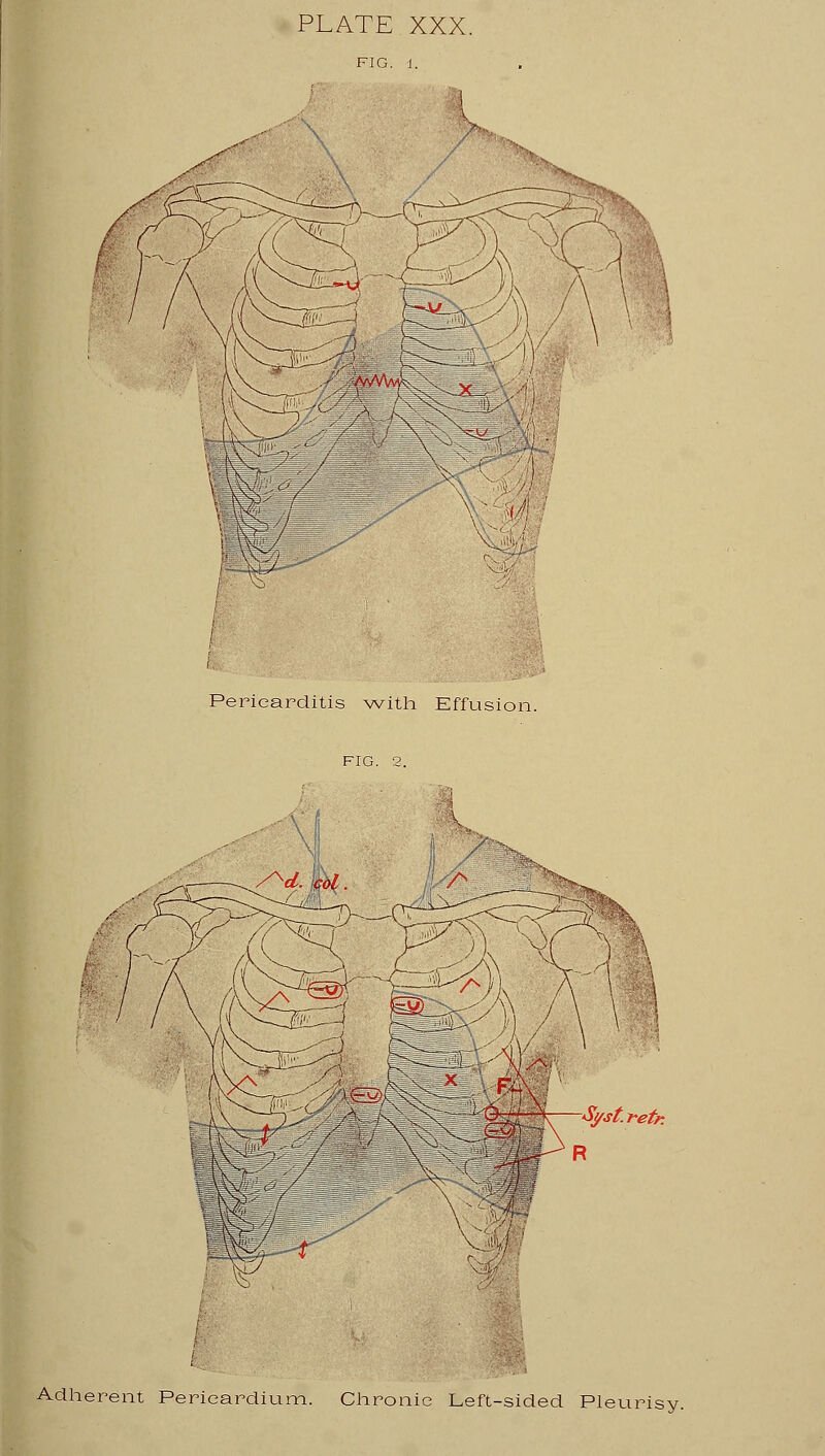 PLATE XXX. CJk Pericarditis with Effusion. Syst. retr. Adherent Pericardium. Chronic Left-sided Pleurisy.