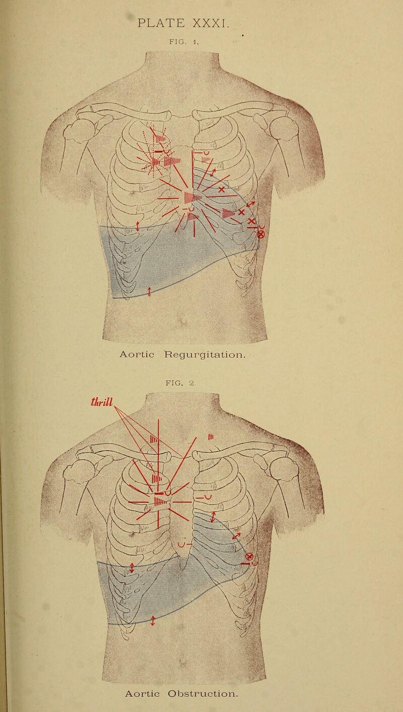 PLATE XXXI. FIG. 1. ^>>> Aortic Regurgitation. Aortic Obstruction.