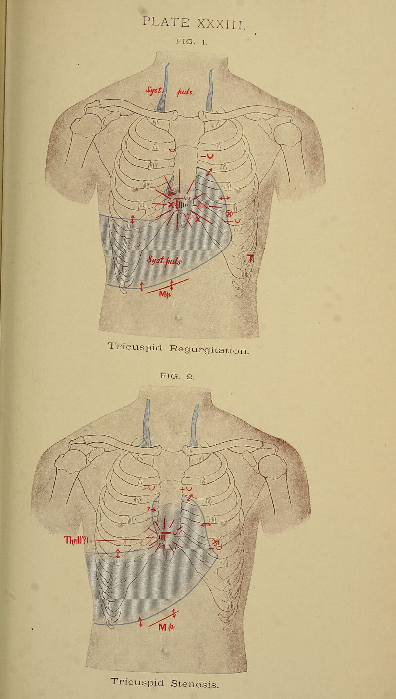 FIG. 1. Tricuspid Regurgitation. FIG. 2. A / TViii(?)4^^7-7:t^f x 5 3 Tricuspid Stenc