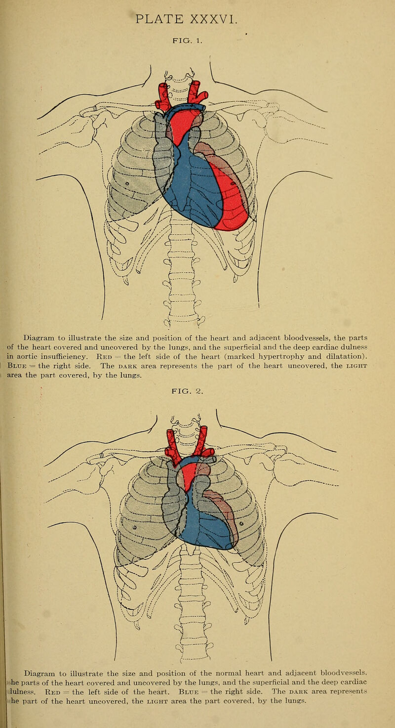 W 1 f TO q r Diagram to illustrate the size and position of the heart and adjacent bloodvessels, the parts of the heart covered and uncovered by the lungs, and the superficial and the deep cardiac dulness in aortic insufficiency. Red = the left side of the heart (marked.hypertrophy and dilatation). Blue = the right side. The dark area represents the part of the heart uncovered, the light area the part covered, by the lungs. FIG. 2. Diagram to illustrate the size and position of the normal heart and adjacent bloodvessels, n.he parts of the heart covered and uncovered by the lungs, and the superficial and the deep cardiac iilulness. Red = the left side of the heart. Blue = the right side. The dark area represents iihe part of the heart uncovered, the light area the part covered, by the lungs.