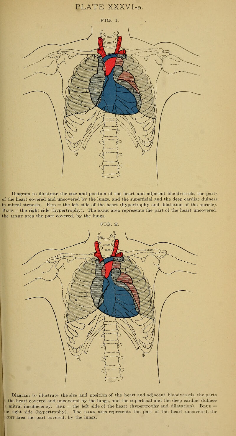 Diagram to illustrate the size and position of the heart and adjacent bloodvessels, the parts of the heart covered and uncovered by the lungs, and the superficial and the deep cardiac dulness in mitral stenosis. Red = the left side of the heart (hypertrophy and dilatation of the auricle). Blue = the right side (hypertrophy). The dark area represents the part of the heart uncovered, the light area the part covered, by the lungs. Diagram to illustrate the size and position of the heart and adjacent bloodvessels, the parts the heart covered and uncovered by the lungs, and the superficial and the deep cardiac dulness mitral insufficiency. Red = the left side of the heart (hypertrophy and dilatation). Blue = ! right side (hypertrophy). The dahk area represents the part of the heart uncovered, the ;ht area the part covered, by the lungs.