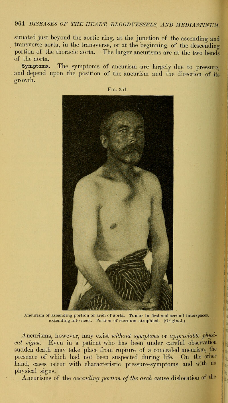 situated just beyond the aortic ring, at the junction of the ascending and transverse aorta, in the transverse, or at the beginning of the descending portion of the thoracic aorta. The larger aneurisms are at the two bends of the aorta. Symptoms. The symptoms of aneurism are largely due to pressure, and depend upon the position of the aneurism and the direction of its growth. Aneurism of ascending portion of arch of aorta. Tumor in first and second interspaces, extending into neck. Portion of sternum atrophied. (Original.) Aneurisms, however, may exist without symptoms or appreciable physi- cal signs. Even in a patient who has been under careful observation sudden death may take place from rupture of a concealed aneurism, the presence of which had not been suspected during life. On the other hand, cases occur with characteristic pressure-symptoms and with no physical signs. | „' Aneurisms of the ascending portion of the arch cause dislocation of the ■