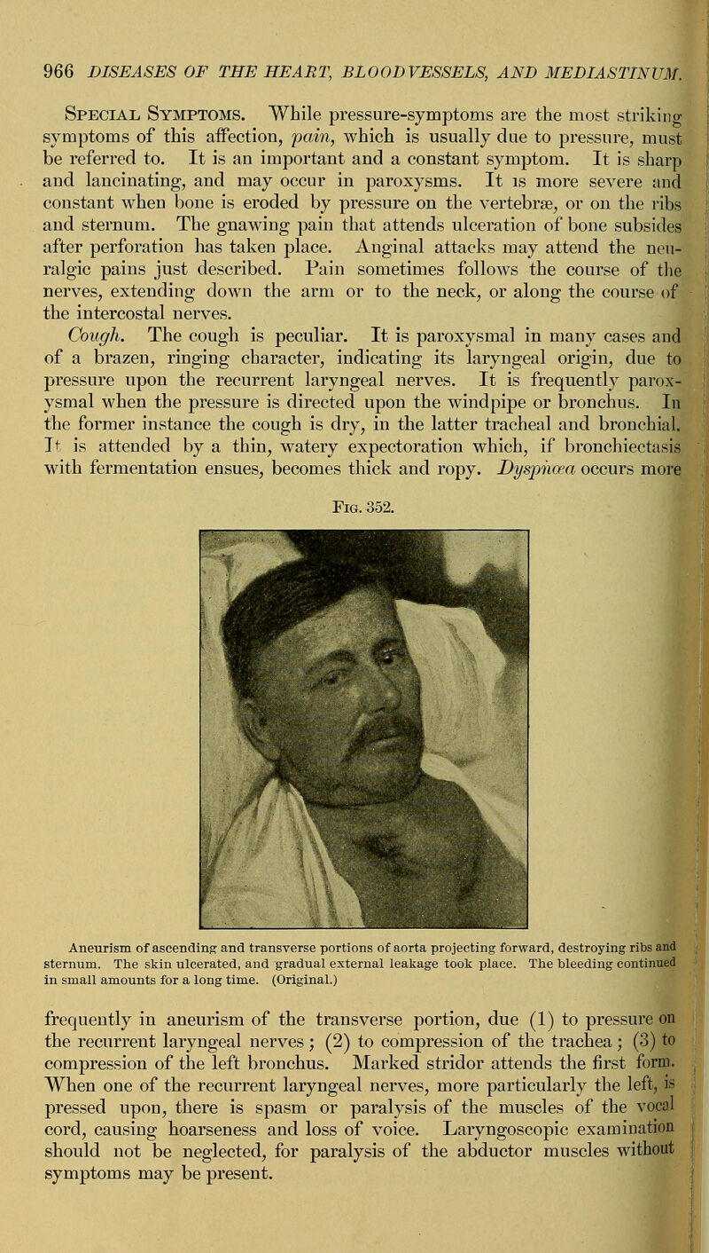 Special Symptoms. While pressure-symptoms are the most striking symptoms of this affection, pain, which is usually due to pressure, must be referred to. It is an important and a constant symptom. It is sharp and lancinating, and may occur in paroxysms. It is more severe and constant when bone is eroded by pressure on the vertebrae, or on the ribs and sternum. The gnawing pain that attends ulceration of bone subsides after perforation has taken place. Anginal attacks may attend the neu- ralgic pains just described. Pain sometimes follows the course of the nerves, extending down the arm or to the neck, or along the course of the intercostal nerves. Cough. The cough is peculiar. It is paroxysmal in many cases and of a brazen, ringing character, indicating its laryngeal origin, due to pressure upon the recurrent laryngeal nerves. It is frequently parox- ysmal when the pressure is directed upon the windpipe or bronchus. In the former instance the cough is dry, in the latter tracheal and bronchial. It is attended by a thin, watery expectoration which, if bronchiectasis with fermentation ensues, becomes thick and ropy. Dyspnoea occurs more Fig. 352. Aneurism of ascending and transverse portions of aorta projecting forward, destroying ribs and sternum. The skin ulcerated, and gradual external leakage took place. The bleeding continued in small amounts for a long time. (Original.) frequently in aneurism of the transverse portion, due (1) to pressure on the recurrent laryngeal nerves ; (2) to compression of the trachea; (3) to compression of the left bronchus. Marked stridor attends the first form. When one of the recurrent laryngeal nerves, more particularly the left, is pressed upon, there is spasm or paralysis of the muscles of the vocal cord, causing hoarseness and loss of voice. Laryngoscopic examination should not be neglected, for paralysis of the abductor muscles without symptoms may be present.