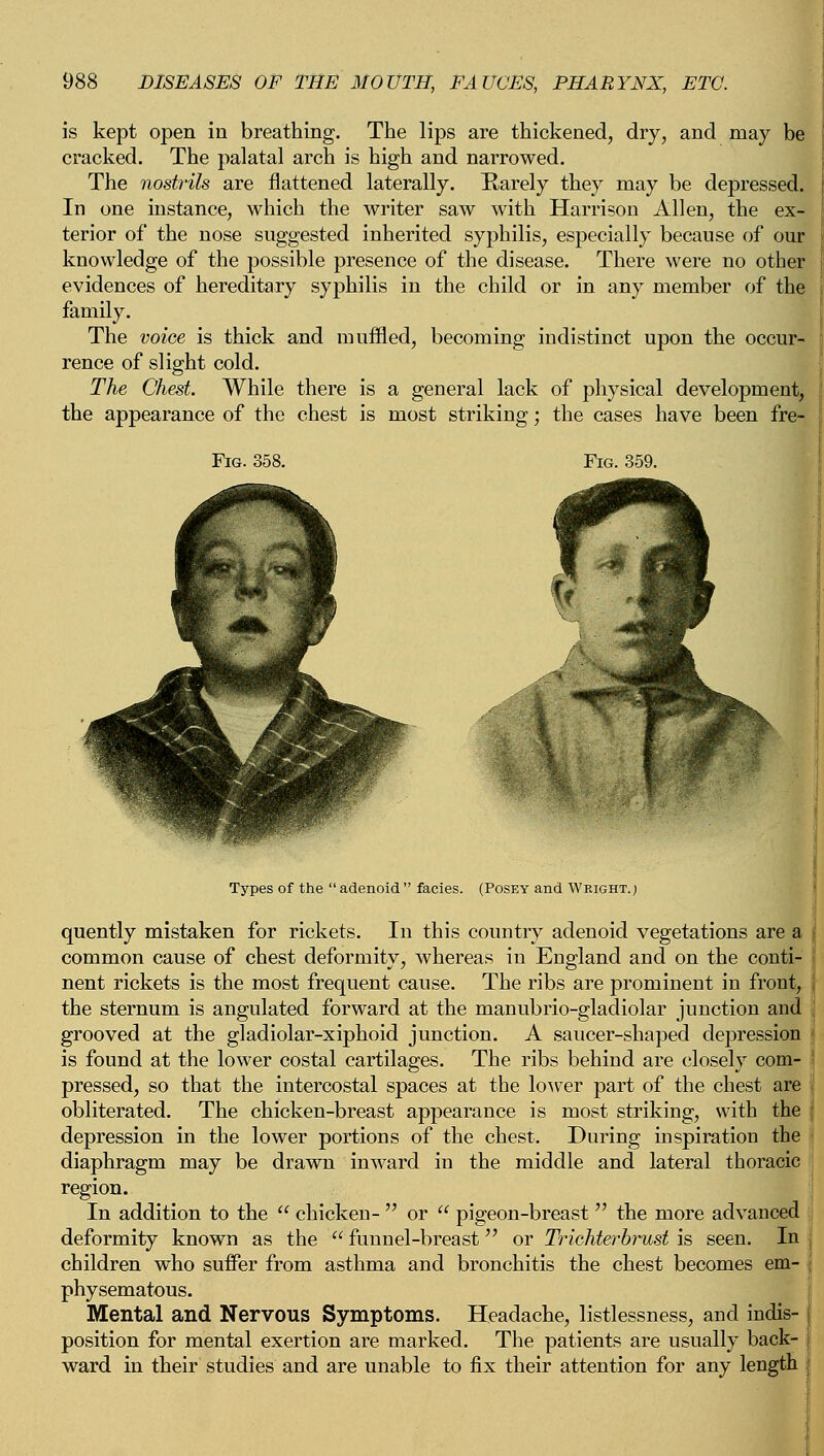 is kept open in breathing. The lips are thickened, dry, and may be cracked. The palatal arch is high and narrowed. The nostrils are flattened laterally. Rarely they may be depressed. In one instance, which the writer saw with Harrison Allen, the ex- terior of the nose suggested inherited syphilis, especially because of our knowledge of the possible presence of the disease. There were no other evidences of hereditary syphilis in the child or in any member of the family. The voice is thick and muffled, becoming indistinct upon the occur- rence of slight cold. The Chest. While there is a general lack of physical development, the appearance of the chest is most striking; the cases have been fre- Fig. 358. Fig. 359. Types of the adenoid facies. (Posey and Wright.; quently mistaken for rickets. In this country adenoid vegetations are a common cause of chest deformity, whereas in England and on the conti- nent rickets is the most frequent cause. The ribs are prominent in front, the sternum is angulated forward at the manubrio-gladiolar junction and grooved at the gladiolar-xiphoid junction. A saucer-shaped depression is found at the lower costal cartilages. The ribs behind are closely com- pressed, so that the intercostal spaces at the lower part of the chest are obliterated. The chicken-breast appearance is most striking, with the depression in the lower portions of the chest. During inspiration the diaphragm may be drawn inward in the middle and lateral thoracic region. In addition to the  chicken-  or  pigeon-breast  the more advanced deformity known as the  funnel-breast or Trichterbrust is seen. In children who suffer from asthma and bronchitis the chest becomes em- physematous. Mental and Nervous Symptoms. Headache, listlessness, and indis- position for mental exertion are marked. The patients are usually back- ward in their studies and are unable to fix their attention for any length