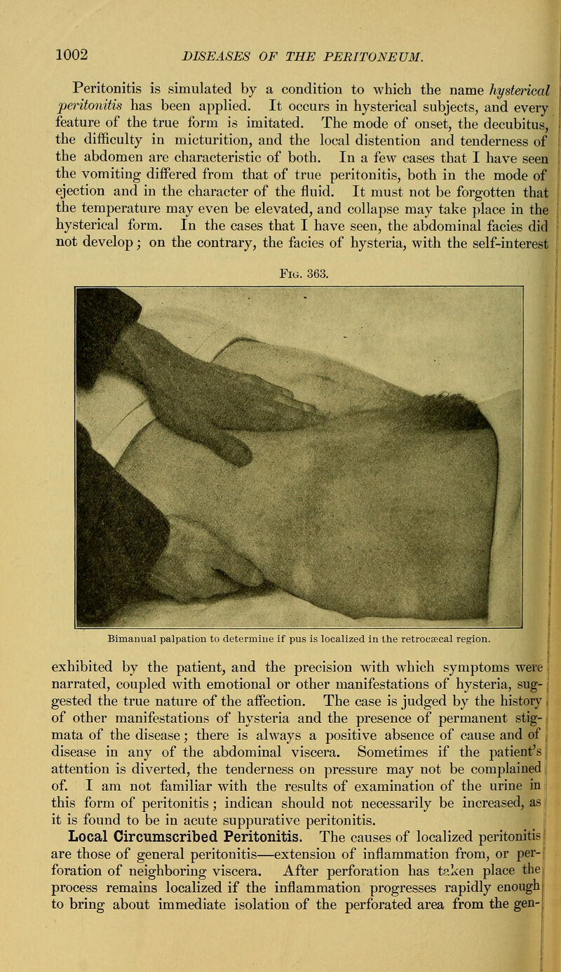 Peritonitis is simulated by a condition to which the name hysterical peritonitis has been applied. It occurs in hysterical subjects, and every feature of the true form is imitated. The mode of onset, the decubitus, the difficulty in micturition, and the local distention and tenderness of the abdomen are characteristic of both. In a few cases that I have seen the vomiting differed from that of true peritonitis, both in the mode of ejection and in the character of the fluid. It must not be forgotten that the temperature may even be elevated, and collapse may take place in the hysterica] form. In the cases that I have seen, the abdominal facies did not develop; on the contrary, the facies of hysteria, with the self-interest Bimanual palpation to determine if pus is localized in the retrocecal region. exhibited by the patient, and the precision with which symptoms were narrated, coupled with emotional or other manifestations of hysteria, sug- gested the true nature of the affection. The case is judged by the history of other manifestations of hysteria and the presence of permanent stig- mata of the disease; there is always a positive absence of cause and of disease in any of the abdominal viscera. Sometimes if the patient's attention is diverted, the tenderness on pressure may not be complained of. I am not familiar with the results of examination of the urine in this form of peritonitis; indican should not necessarily be increased, as it is found to be in acute suppurative peritonitis. Local Circumscribed Peritonitis. The causes of localized peritonitis are those of general peritonitis—extension of inflammation from, or per- foration of neighboring viscera. After perforation has taken place the process remains localized if the inflammation progresses rapidly enough J to bring about immediate isolation of the perforated area from the gen-