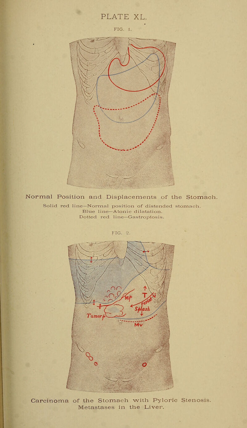 Normal Position and Displacements of the Stomach. Solid red line-Normal position of distended stomach. Blue line—Atonic dilatation. Dotted red line—Gastroptosis. Carcinoma of the Stomach with Pyloric Stenosis. Metastases in the Liver.