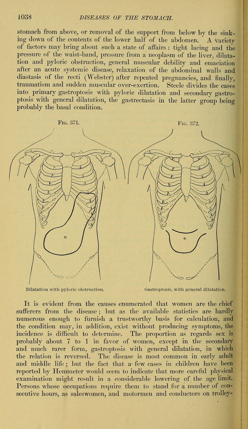 stomach from above, or removal of the support from below by the sink- ing down of the contents of the lower half of the abdomen. A variety of factors may bring about such a state of affairs : tight lacing and the pressure of the waist-band, pressure from a neoplasm of the liver, dilata- tion and pyloric obstruction, general muscular debility and emaciation after an acute systemic disease, relaxation of the abdominal walls and diastasis of the recti (Webster) after repeated pregnancies, and finally, traumatism and sudden muscular over-exertion. Steele divides the cases into primary gastroptosis with pyloric dilatation and secondary gastro- ptosis with general dilatation, the gastrectasis in the latter group being probably the basal condition. Dilatation with pyloric obstruction. Gastroptosis, with general dilatation. It is evident from the causes enumerated that women are the chief sufferers from the disease; but as the available statistics are hardly numerous enough to furnish a trustworthy basis for calculation, and the condition may, in addition, exist without producing symptoms, the incidence is difficult to determine. The proportion as regards sex is probably about 7 to 1 in favor of women, except in the secondary and much rarer form, gastroptosis with general dilatation, in which the relation is reversed. The disease is most common in early adult and middle life; but the fact that aj few cases in children have been reported by Hemmeter would seem to indicate that more careful physical examination might result in a considerable lowering of the age limit. Persons whose occupations require them to stand for a number of con- secutive hours, as saleswomen, and motormen and conductors on trolley-