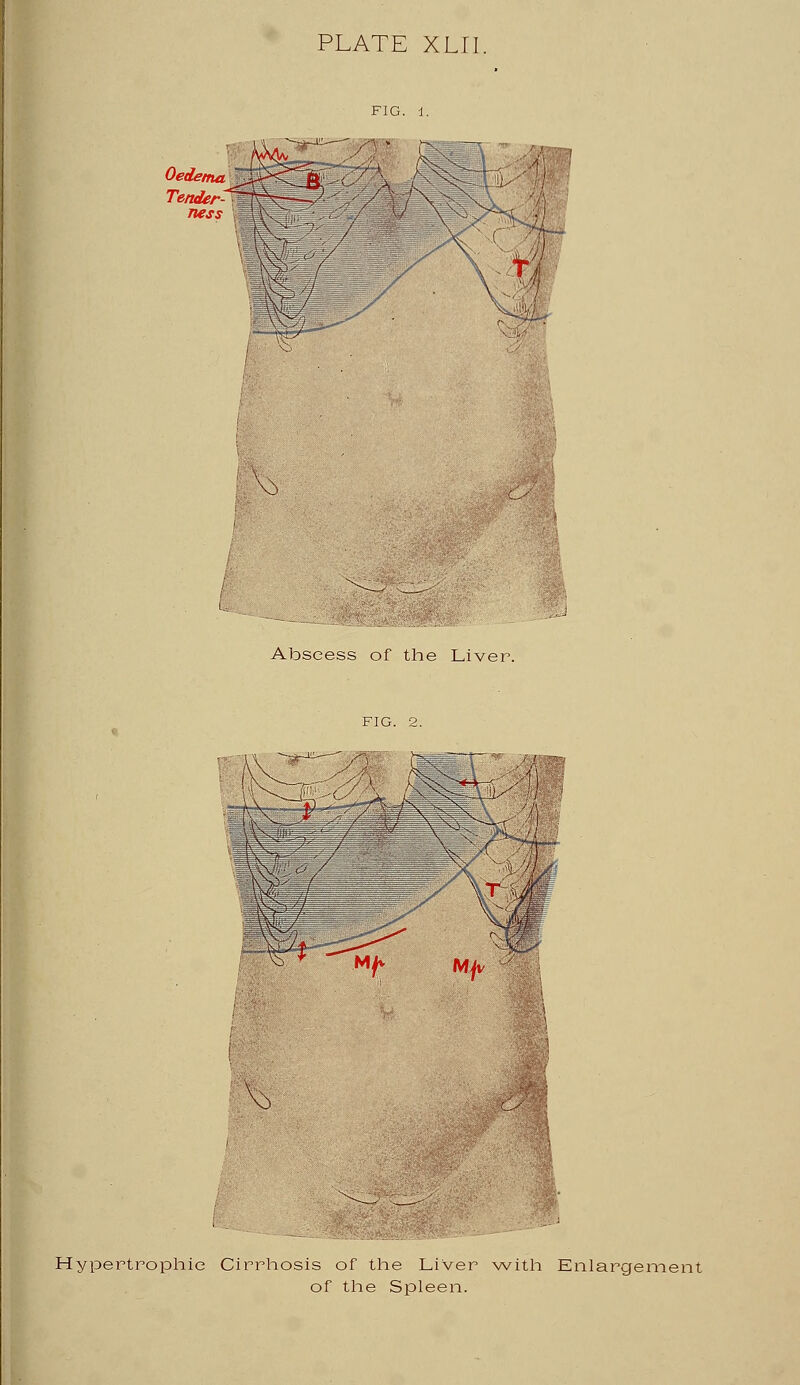 PLATE XLII. Oedema l Tender^ ness I 3^J Abscess of the Liver. IV w Mt Mft Hypertrophic Cirrhosis of the Liver with Enlargement of the Spleen.