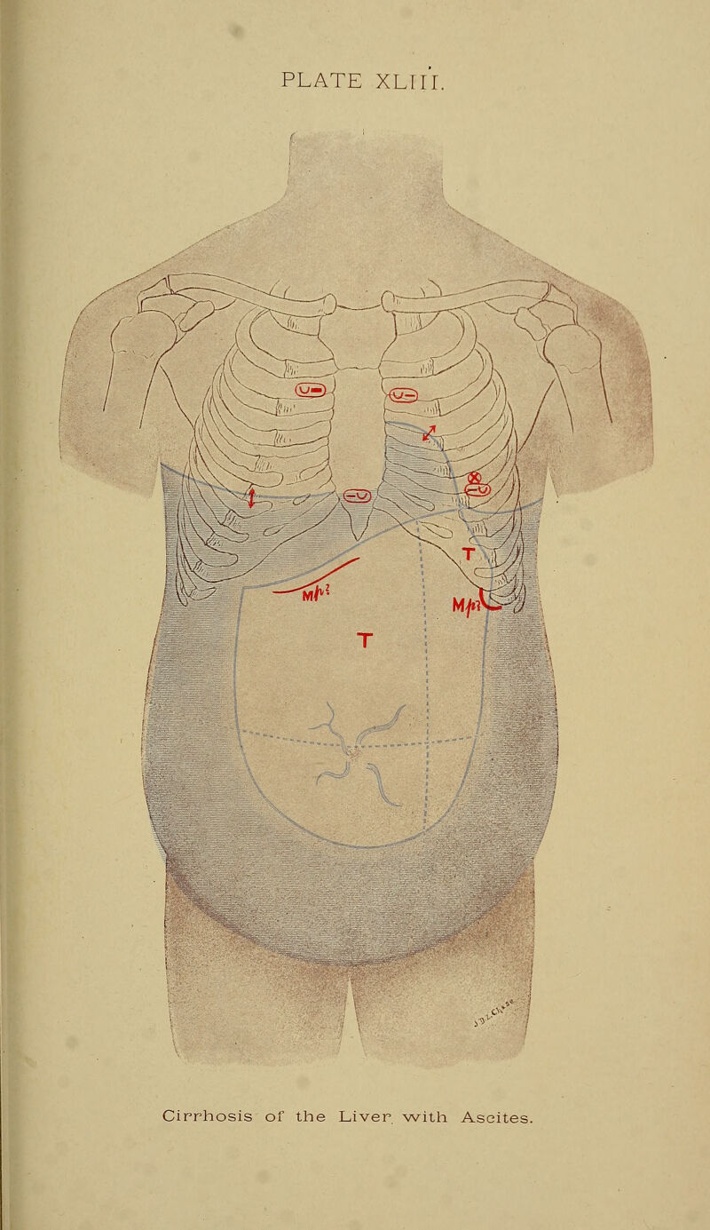 <P Cirrhosis of the Liver with Ascites.