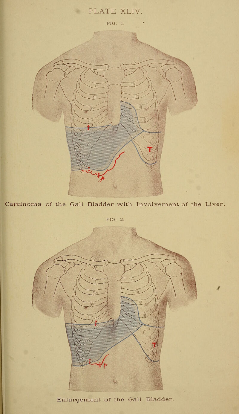 f C VkV %> T Carcinoma of the Gall Bladder with Involvement of the Liver. Enlargement of the Gall Bladder.