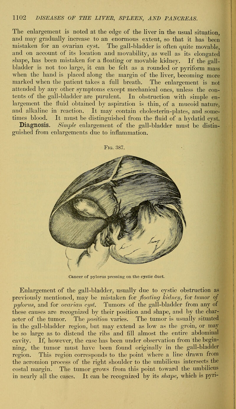 The enlargement is noted at the edge of the liver in the usual situation, and may gradually increase to an enormous extent, so that it has been mistaken for an ovarian cyst. The gall-bladder is often quite movable, and on account of its location and movability, as well as its elongated shape, has been mistaken for a floating or movable kidney. If the gall- bladder is not too large, it can be felt as a rounded or pyriform mass when the hand is placed along the margin of the liver, becoming more marked when the patient takes a full breath. The enlargement is not attended by any other symptoms except mechanical ones, unless the con- tents of the gall-bladder are purulent. In obstruction with simple en- largement the fluid obtained by aspiration is thin, of a mucoid nature, and alkaline in reaction. It may contain cholesterin-plates, and some- times blood. It must be distinguished from the fluid of a hydatid cyst. Diagnosis. Simple enlargement of the gall-bladder must be distin- guished from enlargements due to inflammation. Cancer of pylorus pressing on the cystic duct. Enlargement of the gall-bladder, usually due to cystic obstruction as previously mentioned, may be mistaken for floating kidney, for tumor of pylorus, and for ovarian cyst. Tumors of the gall-bladder from any of these causes are recognized by their position and shape, and by the char- acter of the tumor. The position varies. The tumor is usually situated in the gall-bladder region, but may extend as low as the groin, or may be so large as to distend the ribs and fill almost the entire abdominal cavity. If, however, the case has been under observation from the begin- ning, the tumor must have been found originally in the gall-bladder region. This region corresponds to the point where a line drawn from the acromion process of the right shoulder to the umbilicus intersects the costal margin. The tumor grows from this point toward the umbilicus in nearly all the cases. It can be recognized by its shape, which is pyri-