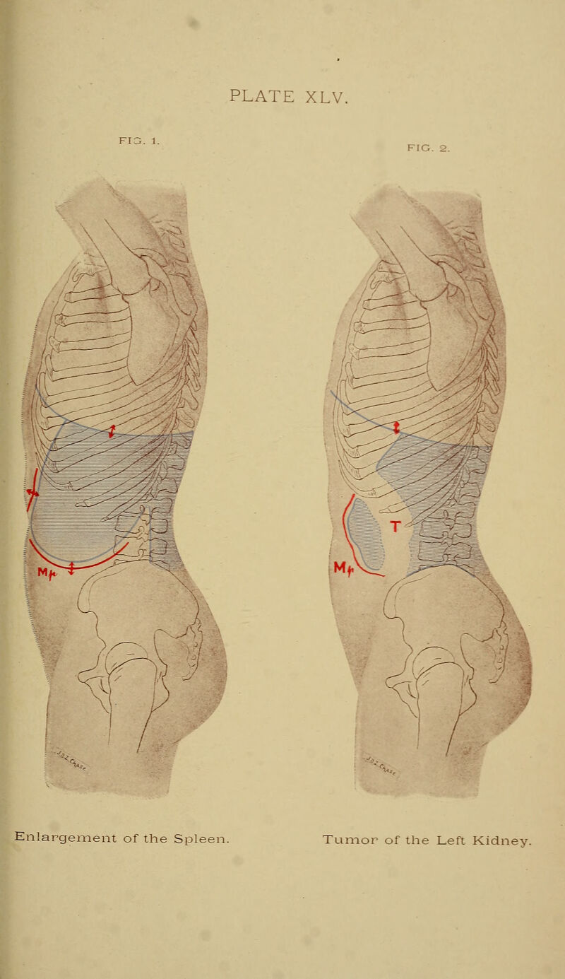 \ Enlargement of the Spleen. Tumor of the Left Kidney.