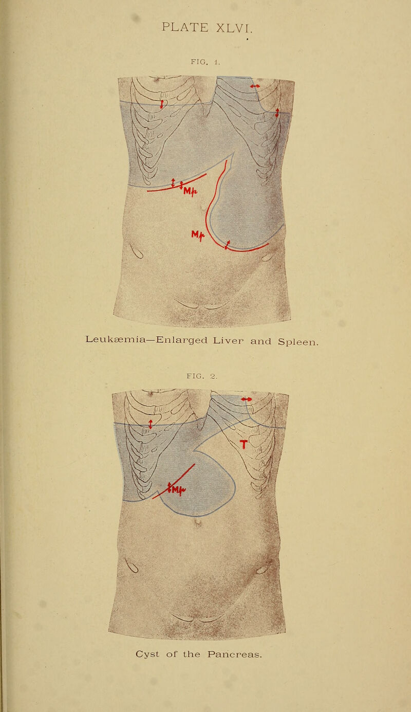 Leukaemia—Enlarged Liver and Spleen. V) Cyst of the Pancreas.