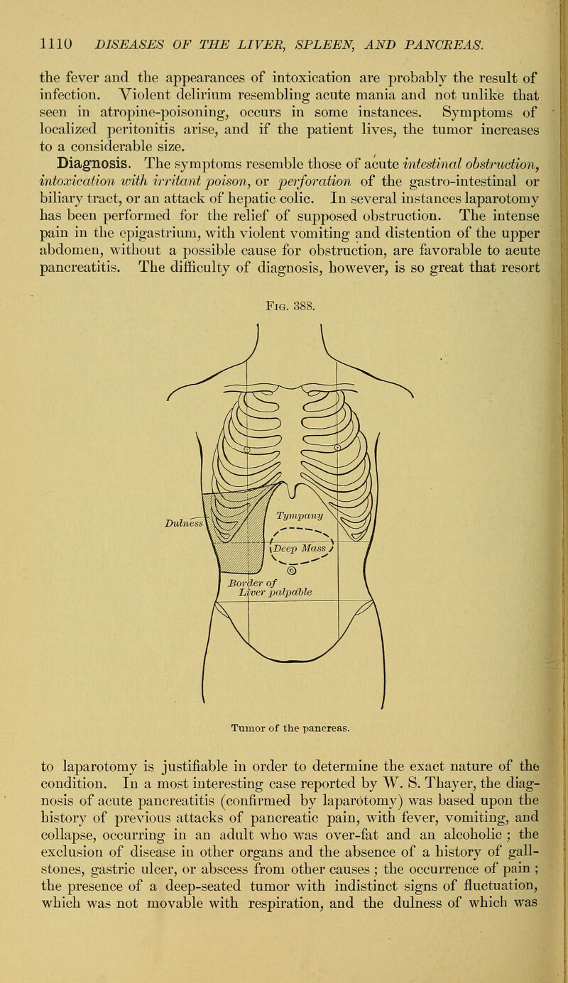 the fever and the appearances of intoxication are probably the result of infection. Violent delirium resembling acute mania and not unlike that seen in atropine-poisoning, occurs in some instances. Symptoms of localized peritonitis arise, and if the patient lives, the tumor increases to a considerable size. Diagnosis. The symptoms resemble those of acute intestinal obstruction, intoxication with irritant poison, or -perforation of the gastro-intestinal or biliary tract, or an attack of hepatic colic. In several instances laparotomy has been performed for the relief of supposed obstruction. The intense pain in the epigastrium, with violent vomiting and distention of the upper abdomen, without a possible cause for obstruction, are favorable to aeute pancreatitis. The difficulty of diagnosis, however, is so great that resort Fig. 388. Tumor of the pancreas. to laparotomy is justifiable in order to determine the exact nature of the condition. In a most interesting case reported by W. S. Thayer, the diag- nosis of acute pancreatitis (confirmed by laparotomy) was based upon the history of previous attacks of pancreatic pain, with fever, vomiting, and collapse, occurring in an adult who was over-fat and an alcoholic ; the exclusion of disease in other organs and the absence of a history of gall- stones, gastric ulcer, or abscess from other causes ; the occurrence of pain ; the presence of a deep-seated tumor with indistinct signs of fluctuation, which was not movable with respiration, and the dulness of which was