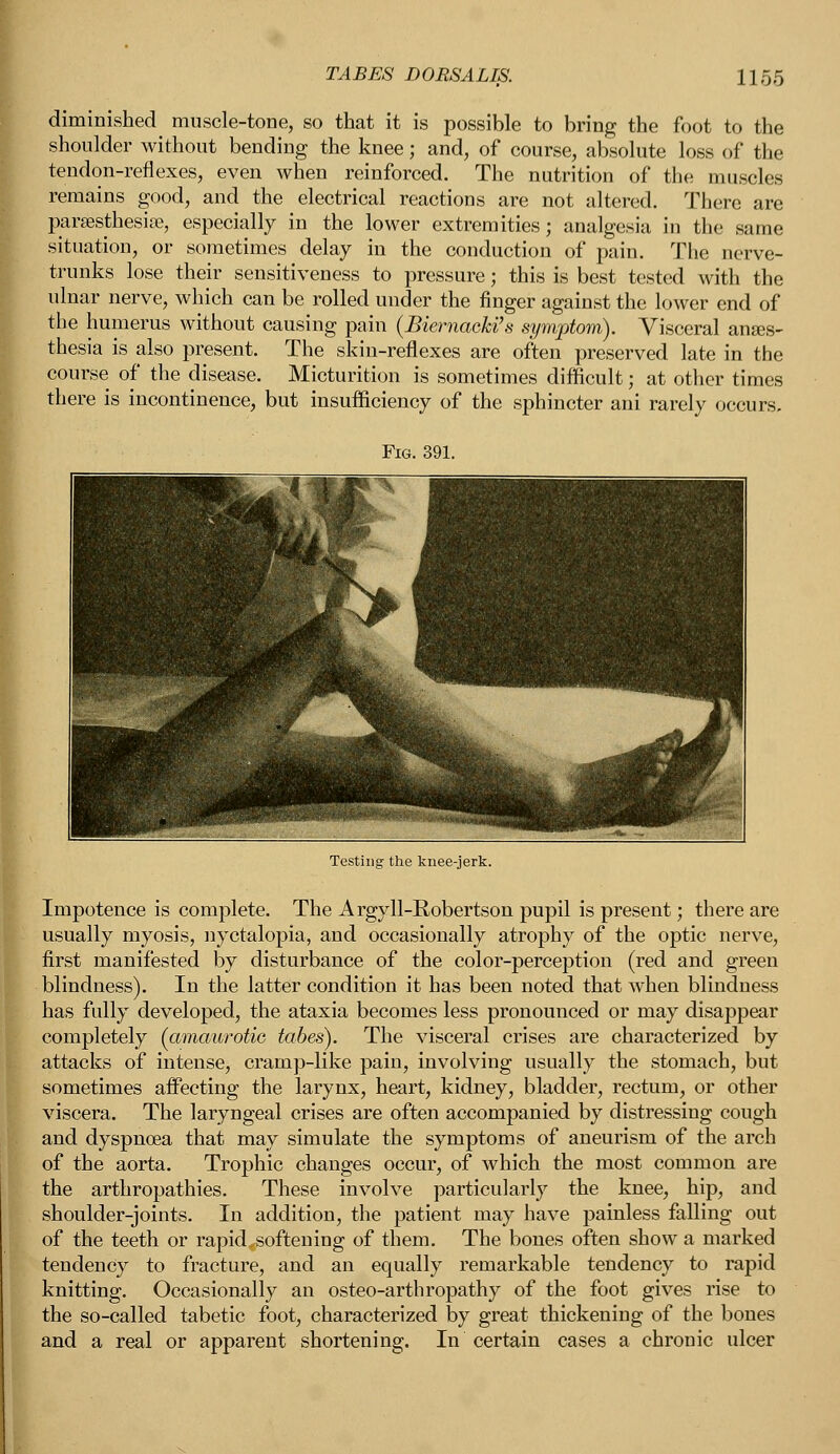 diminished muscle-tone, so that it is possible to bring the foot to the shoulder without bending the knee; and, of course, absolute loss of the tendon-reflexes, even when reinforced. The nutrition of the muscles remains good, and the electrical reactions are not altered. There are paramnesia?, especially in the lower extremities; analgesia in the same situation, or sometimes delay in the conduction of pain. The nerve- trunks lose their sensitiveness to pressure; this is best tested with the ulnar nerve, which can be rolled under the finger against the lower end of the humerus without causing pain (Biernacki's symptom). Visceral anses- thesia is also present. The skin-reflexes are often preserved late in the course of the disease. Micturition is sometimes difficult; at other times there is incontinence, but insufficiency of the sphincter ani rarely occurs. Testing the knee-jerk. Impotence is complete. The Argyll-Robertson pupil is present; there are usually myosis, nyctalopia, and occasionally atrophy of the optic nerve, first manifested by disturbance of the color-perception (red and green blindness). In the latter condition it has been noted that when blindness has fully developed, the ataxia becomes less pronounced or may disappear completely (amaurotic tabes). The visceral crises are characterized by attacks of intense, cramp-like pain, involving usually the stomach, but sometimes affecting the larynx, heart, kidney, bladder, rectum, or other viscera. The laryngeal crises are often accompanied by distressing cough and dyspnoea that may simulate the symptoms of aneurism of the arch of the aorta. Trophic changes occur, of which the most common are the arthropathies. These involve particularly the knee, hip, and shoulder-joints. In addition, the patient may have painless falling out of the teeth or rapid,softening of them. The bones often show a marked tendency to fracture, and an equally remarkable tendency to rapid knitting. Occasionally an osteo-arthropathy of the foot gives rise to the so-called tabetic foot, characterized by great thickening of the bones and a real or apparent shortening. In certain cases a chronic ulcer