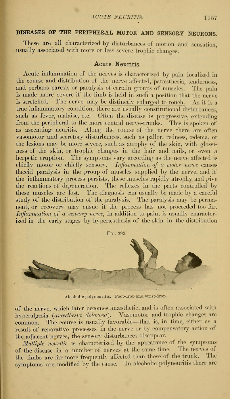 ACUTE NEURITIS. 11<37 DISEASES OF THE PERIPHERAL MOTOR AND SENSORY NEURONS. These are all characterized by disturbances of motion and sensation, usually associated with more or less severe trophic changes. Acute Neuritis. Acute inflammation of the nerves is characterized by pain localized in the course and distribution of the nerve affected, paresthesia, tenderness, and perhaps paresis or paralysis of certain groups of muscles. The pain is made more severe if the limb is held in such a position that the nerve is stretched. The nerve may be distinct])' enlarged to touch. As it is a true inflammatory condition, there are usually constitutional disturbances, such as fever, malaise, etc. Often the disease is progressive, extending from the peripheral to the more central nerve-trunks. This is spoken of as ascending neuritis. Along the course of the nerve there are often vasomotor and secretory disturbances, such as pallor, redness, oedema, or the lesions may be more severe, such as atrophy of the skin, with glossi- ness of the skin, or trophic changes in the hair and nails, or even a herpetic eruption. The symptoms vary according as the- nerve affected is chiefly motor or chiefly sensory. Inflammation of a motor nerve causes flaccid paralysis in the group of muscles supplied by the nerve, and if the inflammatory process persists, these muscles rapidly atrophy and give the reactions of degeneration. The reflexes in the parts controlled by these muscles are lost. The diagnosis can usually be made by a careful study of the distribution of the paralysis. The paralysis may be perma- nent, or recovery may ensue if the process has not proceeded too far. Inflammation of a sensory nerve, in addition to pain, is usually character- ized in the early stages by hyperesthesia of the skin in the distribution i * Alcoholic polyneuritis. Foot-drop and wrist-drop. of the nerve, which later becomes anaesthetic, and is often associated with hyperalgesia {anesthesia dolorosa). Vasomotor and trophic changes are common. The course is usually favorable—that is, in time, either as a result of reparative processes in the nerve or by compensatory action of the adjacent nerves, the sensory disturbances disappear. Multiple neuritis is characterized by the appearance of the symptoms of the disease in a number of nerves at the same time. The nerves of the limbs are far more frequently affected than those of the trunk. The symptoms are modified by the cause. In alcoholic polyneuritis there are