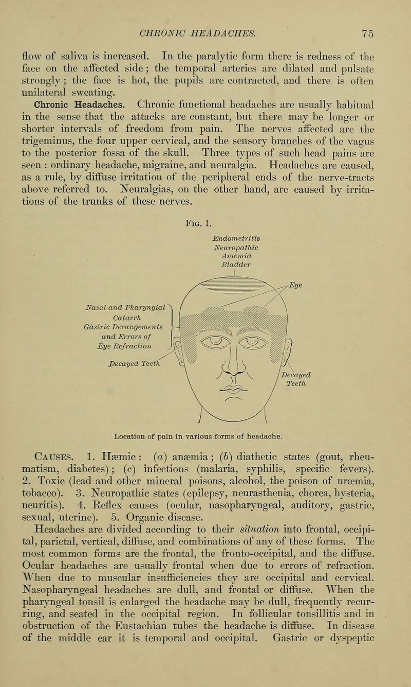 flow of saliva is iucreased. In the paralytic form there is redness of the face on the alfected side; the temporal arteries are dilated and pulsate strongly ; the face is hot, the pupils are contracted, and there is often unilateral sweating. Chronic Headaches. Chronic functional headaches are usually habitual in the sense that the attacks are constant, but there may be longer or shorter intervals of freedom from pain. The nerves aflPected are the trigeminus, the four upper cervical, and the sensory branches of the vagus to the posterior fossa of the skull. Three types of such head pains are seen : ordinary headache, migraine, and neuralgia. Headaches are caused, as a rule, by dilFuse irritation of the peripheral ends of the nerve-tracts above referred to. Neuralgias, on the other hand, are caused by irrita- tions of the trunks of these nerves. Fig. 1. Endometritis Neuropathic Ancem ia Bladder Xasal and Pliaryngial Catarrh Gastric Derangements and Errors of Eye Refraction Decayed Teeth Location of pain in various forms of headache. Causes. 1. Hsemic : (a) anaemia; (6) diathetic states (gout, rheu- matism, diabetes); (c) infections (malaria, syphilis, specific fevers). 2. Toxic (lead and other mineral poisons, alcohol, the poison of uraemia, tobacco). 3. Neuropathic states (epilepsy, neurasthenia, chorea, hysteria, neuritis). 4. Reflex caases (ocular, nasopharyngeal, auditory, gastric, sexual, uterine). 5. Organic disease. Headaches are divided according to their situation into frontal, occipi- tal, parietal, vertical, diffuse, and combinations of any of these forms. The most common forms are the frontal, the fronto-occipital, and the diffuse. Ocular headaches are usually frontal when due to errors of refraction. When due to muscular insufficiencies they are occipital and cervical. Nasopharyngeal headaches are dull, and frontal or diffuse. When the pharyngeal tonsil is enlarged the headache may be dull, frequently recur- ring, and seated in the occipital region. In follicular tonsillitis and in obstruction of the Eustachian tubes the headache is diffuse. In disease of the middle ear it is temporal and occipital. Gastric or dyspeptic