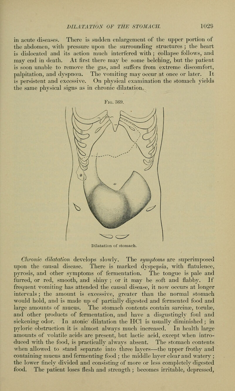 ill acute di^^eases. There is sudden enlargemeut of the upper portion of the abdomen, with pressure upon the surrounding structures ; the heart is dislocated and its action much interfered with; collapse follows, and may end in death. At first there may be some belching, but the patient is soon unable to remove the gas, and suffers from extreme discomfort, palpitation, and dyspn(va. The vomiting may occur at once or later. It is persistent and excessive. On physical examination the stomach yields the same physical signs as in chronic dilatation. Fig. 369. Dilatation of stomach. Chronic dilatation develops slowly. The symptoms are superimposed upon the causal disease. There is marked dyspepsia, with flatulence, pyrosis, and other symptoms of fermentation. The tongue is pale and furred, or red, smooth, and shiny ; or it may be soft and flabby. If frequent vomiting has attended the causal disease, it now occurs at longer intervals; the amount is excessive, greater than the normal stomach would hold, and is made up of partially digested and fermented food and large amounts of mucus. The stomach contents contain sarcinae, torulse, and other products of fermentation, and have a disgustingly foul and sickening odor. In atonic dilatation the HCl is usually diminished; in pyloric obstruction it is almost always much increased. In health large amounts of volatile acids are present, but lactic acid, except when intro- duced with the food, is practically always absent. The stomach contents when allowed to stand separate into three layers—the upper frothy and containing mucus and fermenting food ; the middle layer clear and watery ; the lower finely divided and consisting of more or less completely digested food. The patient loses flesh and strength ; becomes irritable, depressed,