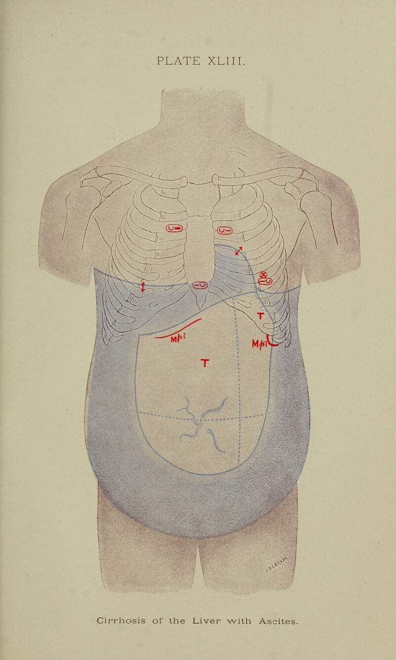 1 , o' Cirrhosis of the Liver with Ascites.