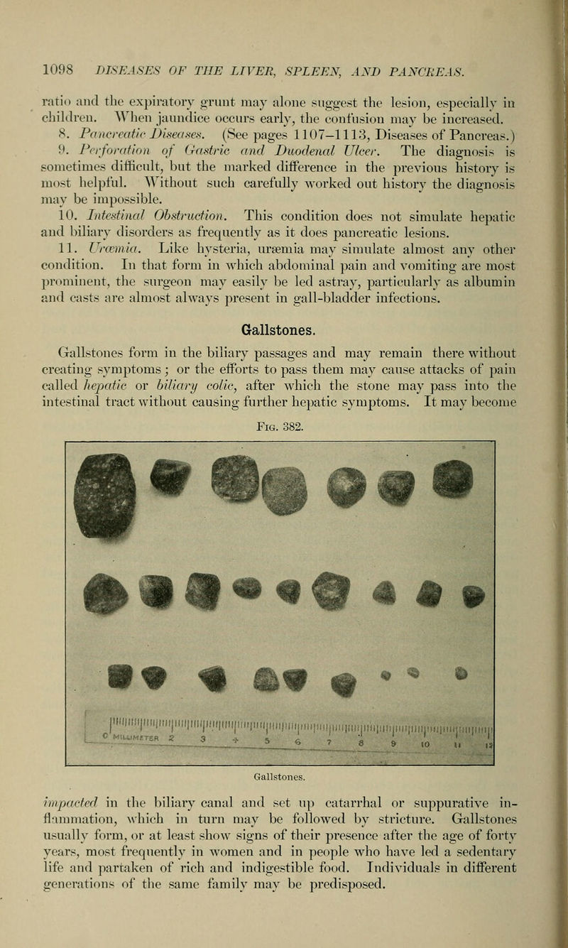 ratio and the expiratory gruiit may alone suggest the lesion, especially in children. When jaundice occurs early, the confusion may be increased. S. Pancreatic Disea.sea. (Seepages 1107-1113, Diseases of Pancreas.) 9. Perforation of Gastric and Duodenal Ulcer. The diagnosis is sometimes difficult, but the marked difference in the previous history is most helpful. Without such carefully worked out history the diagnosis may be impossible. 10. Intestincd Obstruction. This condition does not simulate hepatic and biliary disorders as frequently as it does pancreatic lesions. 11. Uramiia. Like hysteria, uraemia may simulate almost any other condition. In that form in which abdominal pain and yomiting are most prominent, the surgeon may easily be led astray, particularly as albumin and casts are almost always present in gall-bladder infections. Gallstones. Gallstones form in the biliary passages and may remain there without creating symptoms; or the efforts to pass them may cause attacks of pain called hejxdic or bUiary colic, after which the stone may pass into the intestinal tract without causing further hepatic symptoms. It may become Fig. 382. #««««9««» • « « tk9 m  * ^ 10 U IS Gallstones. impacted in the biliary canal and set up catarrhal or suppurative in- flammation, \\hich in turn may be followed by stricture. Gallstones usually form, or at least show signs of their presence after the age of forty years, most frequently in women and in people who have led a sedentary life and partaken of rich and indigestible food. Individuals in different generations of the same family may be predisposed.