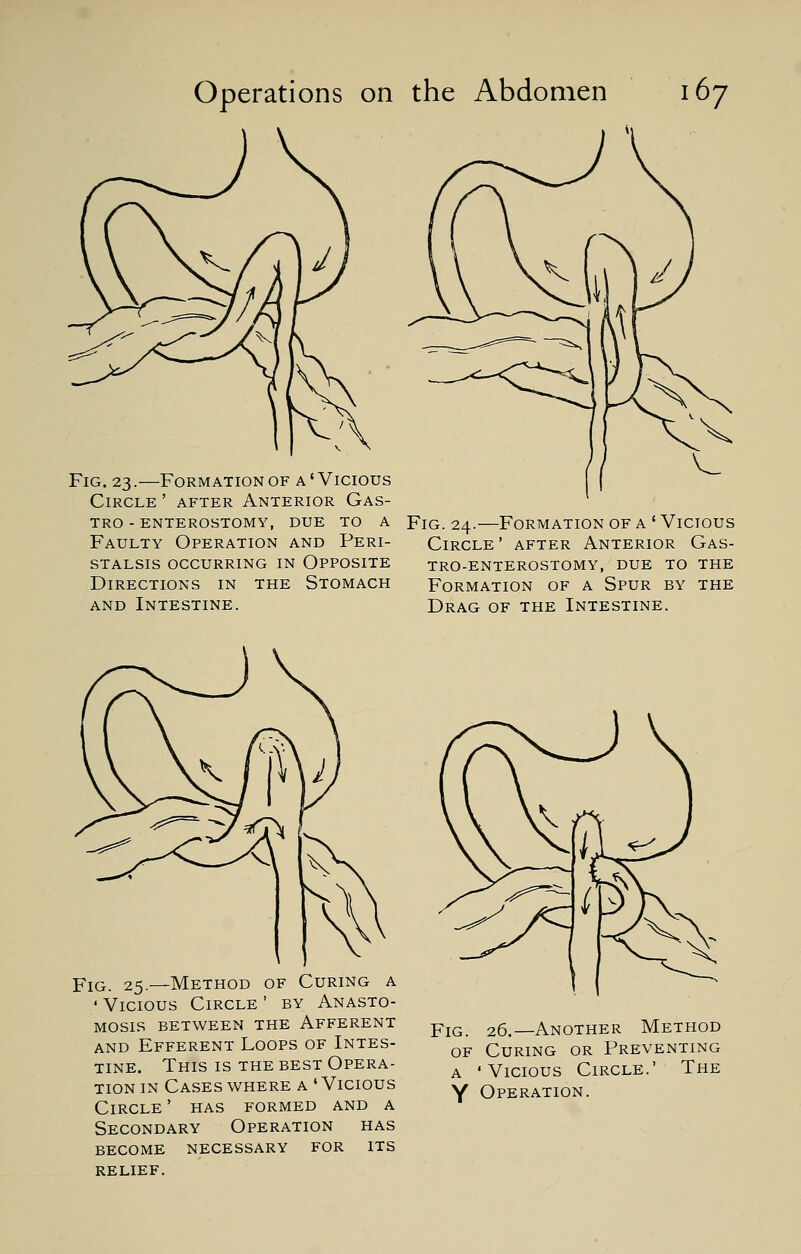 Fig. 23.—Formation of a'Vicious Circle ' after Anterior Gas- tro - enterostomy, due to a Faulty Operation and Peri- stalsis OCCURRING IN OPPOSITE Directions in the Stomach and Intestine. Fig. 24.—Formation of a ' Vicious Circle' after Anterior Gas- troenterostomy, due to the Formation of a Spur by the Drag of the Intestine. Fig. 25.—Method of Curing a • Vicious Circle ' by Anasto- mosis between the Afferent and Efferent Loops of Intes- tine. This is the best Opera- tion in Cases where a ' Vicious Circle ' has formed and a Secondary Operation has become necessary for its relief. Fig. 26.—Another Method of Curing or Preventing a 'Vicious Circle.' The Y Operation.