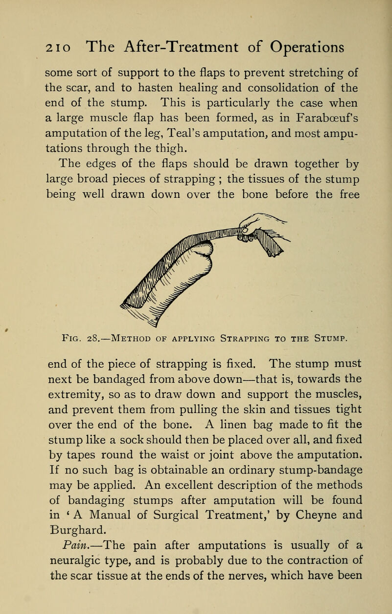 some sort of support to the flaps to prevent stretching of the scar, and to hasten healing and consolidation of the end of the stump. This is particularly the case when a large muscle flap has been formed, as in Farabceuf's amputation of the leg, Teal's amputation, and most ampu- tations through the thigh. The edges of the flaps should be drawn together by large broad pieces of strapping ; the tissues of the stump being well drawn down over the bone before the free Fig. 28.—Method of applying Strapping to the Stump. end of the piece of strapping is fixed. The stump must next be bandaged from above down—that is, towards the extremity, so as to draw down and support the muscles, and prevent them from pulling the skin and tissues tight over the end of the bone. A linen bag made to fit the stump like a sock should then be placed over all, and fixed by tapes round the waist or joint above the amputation. If no such bag is obtainable an ordinary stump-bandage may be applied. An excellent description of the methods of bandaging stumps after amputation will be found in ' A Manual of Surgical Treatment,' by Cheyne and Burghard. Pain.—The pain after amputations is usually of a neuralgic type, and is probably due to the contraction of the scar tissue at the ends of the nerves, which have been