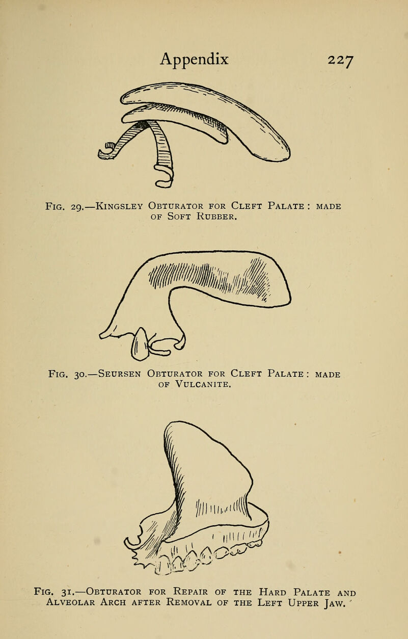 Fig. 29.—Kingsley Obturator for Cleft Palate : made of Soft Rubber. Fig. 30.—Seursen Obturator for Cleft Palate : made of Vulcanite. Fig. 31.—Obturator for Repair of the Hard Palate and Alveolar Arch after Removal of the Left Upper Jaw. '