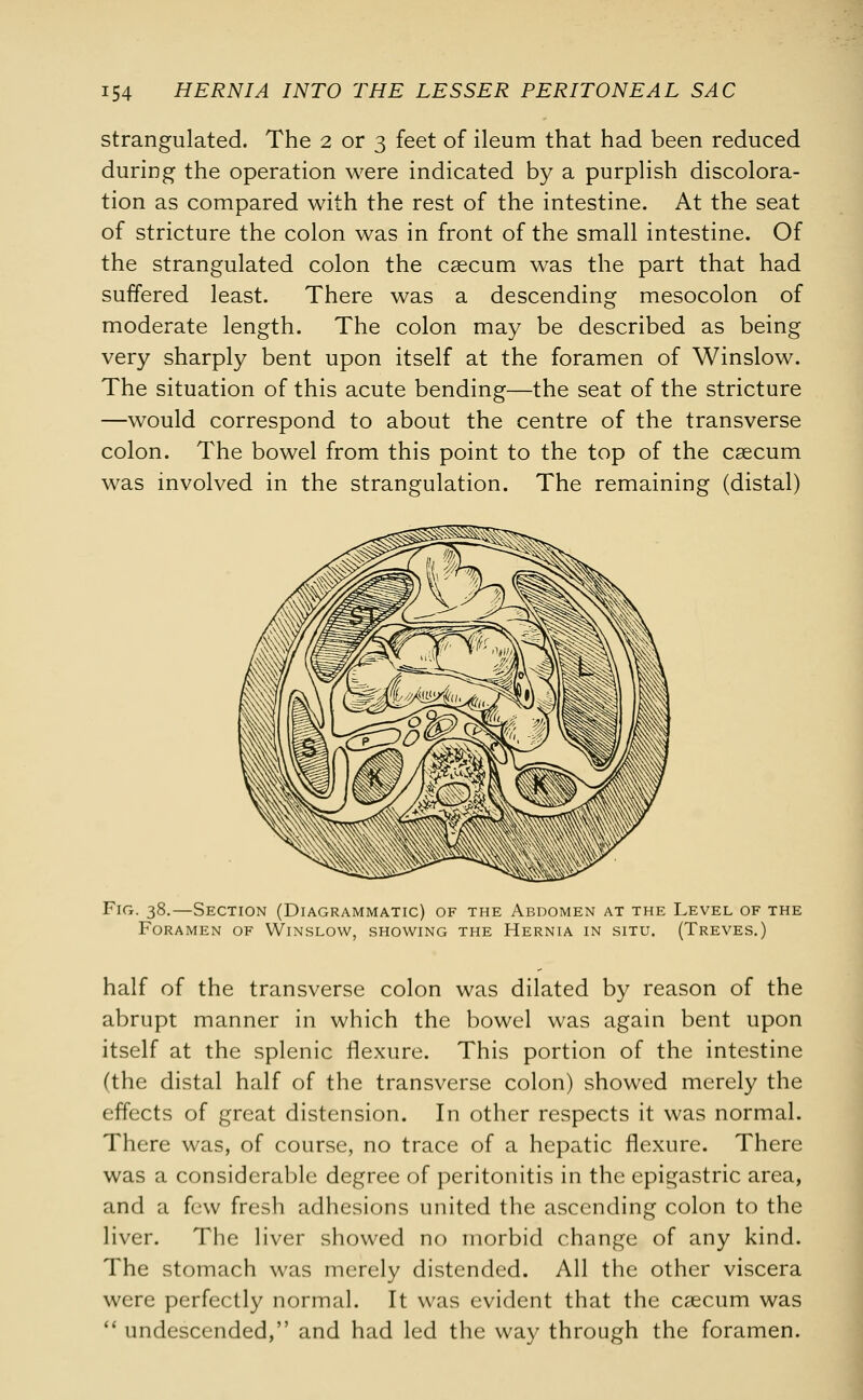 strangulated. The 2 or 3 feet of ileum that had been reduced during the operation were indicated by a purplish discolora- tion as compared with the rest of the intestine. At the seat of stricture the colon was in front of the small intestine. Of the strangulated colon the caecum was the part that had suffered least. There was a descending mesocolon of moderate length. The colon may be described as being very sharply bent upon itself at the foramen of Winslow. The situation of this acute bending—the seat of the stricture —would correspond to about the centre of the transverse colon. The bowel from this point to the top of the caecum was involved in the strangulation. The remaining (distal) Fig. 38.—Section (Diagrammatic) of the Abdomen at the Level of the Foramen of Winslow, showing the Hernia in situ. (Treves.) half of the transverse colon was dilated by reason of the abrupt manner in which the bowel was again bent upon itself at the splenic flexure. This portion of the intestine (the distal half of the transverse colon) showed merely the effects of great distension. In other respects it was normal. There was, of course, no trace of a hepatic flexure. There was a considerable degree of peritonitis in the epigastric area, and a few fresh adhesions united the ascending colon to the liver. The liver showed no morbid change of any kind. The stomach was merely distended. All the other viscera were perfectly normal. It was evident that the caecum was  undescended, and had led the way through the foramen.