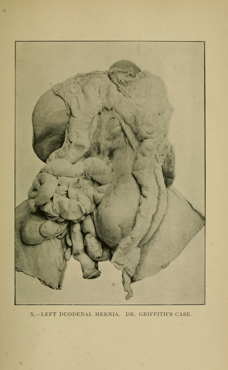 X.—LEFT DUODENAL HERNIA. DR. GRIFFITH'S CASE.