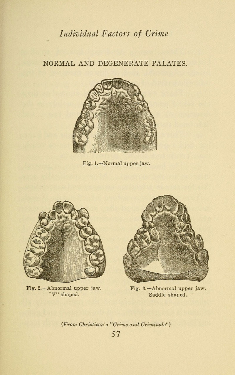 NORMAL AND DEGENERATE PALATES. SJSiJ^?!/i4g%|5f2fWsK¥?--;SSJ?!5S Fig. 1.—Normal upper jaw. Fig. 2.—Abnormal upper jaw. V shaped. Fig. 3.—Abnormal upper jaw. Saddle shaped. {From Christison's Crime and Criminals)