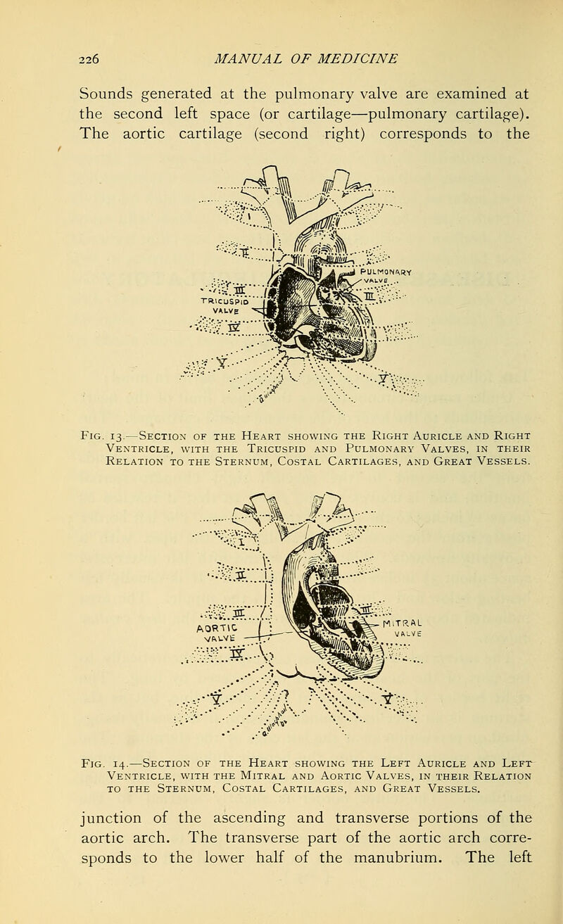 Sounds generated at the pulmonary valve are examined at the second left space (or cartilage—pulmonary cartilage). The aortic cartilage (second right) corresponds to the Fig. 13.—Section of the Heart showing the Right Auricle and Right Ventricle, with the Tricuspid and Pulmonary Valves, in their Relation to the Sternum, Costal Cartilages, and Great Vessels. ••.*■ Fig. 14.—Section of the Heart showing the Left Auricle and Left Ventricle, with the Mitral and Aortic Valves, in their Relation to the Sternum, Costal Cartilages, and Great Vessels. junction of the ascending and transverse portions of the aortic arch. The transverse part of the aortic arch corre- sponds to the lower half of the manubrium. The left