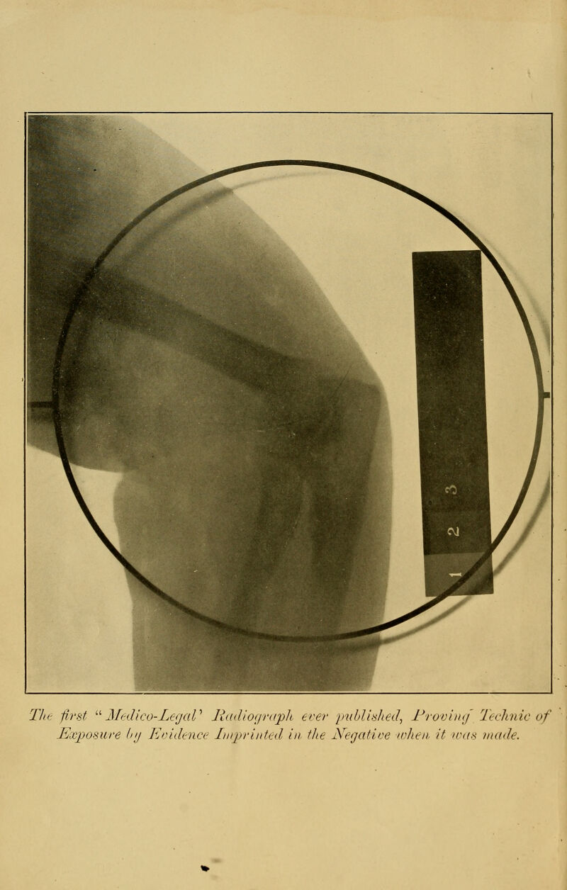 The first '•^ Mfdico-Le<jaV JiddiograpJi ever imhlished^ Fro'vimj Teclinic of Exposure Inj Evidence Inqyrinted in. the Negative luheii it nuis made.