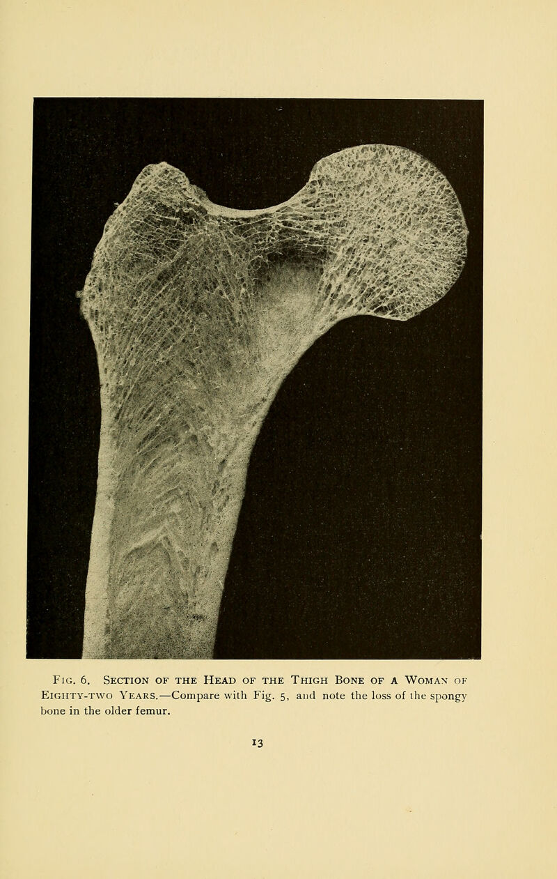 Eighty-two Years.—Compare with Fig. 5, and note the loss of ihe spongy bone in the older femur.