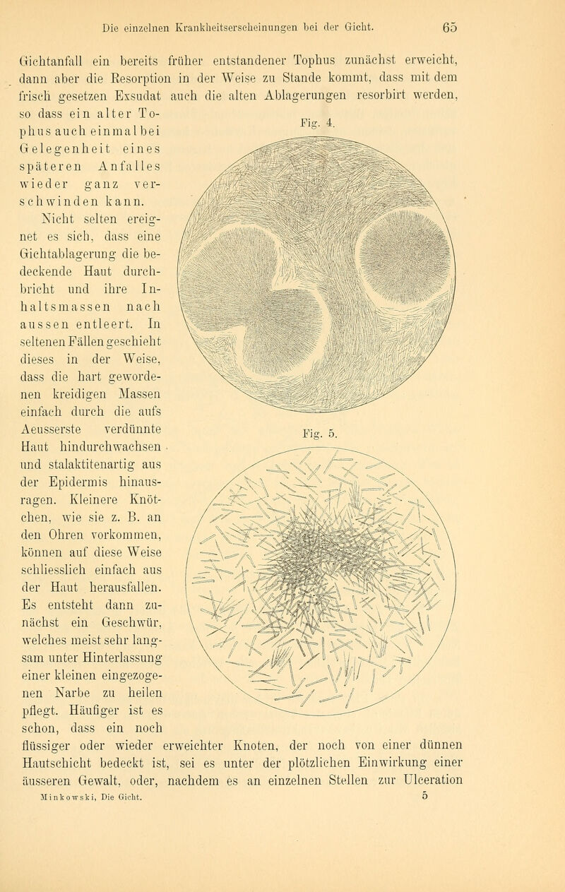 Fu Gichtanfall ein bereits früher entstandener Tophus zunächst erweicht, dann aber die Eesorption in der Weise zu Stande kommt, dass mit dem frisch gesetzen Exsudat auch die alten Ablagerungen resorbirt werden, so dass ein alter To- phus auch einmal bei Gelegenheit eines späteren A n f a 11 e s wieder ganz ver- schwinden kann. Nicht selten ereig- net es sich, dass eine Gichtablagerung die be- deckende Haut durch- bricht und ihre In- haltsmassen nach aussen entleert. In seltenen Fällen geschieht dieses in der Weise, dass die hart geworde- nen kreidigen Massen einfach durch die aufs Aeusserste verdünnte Haut hindurchwachsen und stalaktitenartig aus der Epidermis hinaus- ragen. Kleinere Knöt- chen, wie sie z. B. an den Ohren vorkommen, können auf diese Weise schliesslich einfach aus der Haut herausfallen. Es entsteht dann zu- nächst ein Geschwür, welches meist sehr lang- sam unter Hinterlassung einer kleinen eingezoge- nen Narbe zu heilen pflegt. Häufiger ist es schon, dass ein noch flüssiger oder wieder erweichter Knoten, der noch von einer dünnen Hautschicht bedeckt ist, sei es unter der plötzlichen Einwirkung einer äusseren Gewalt, oder, nachdem es an einzelnen Stellen zur Ulceration Minkowski, Die Giclit. 5 Fis. 5.