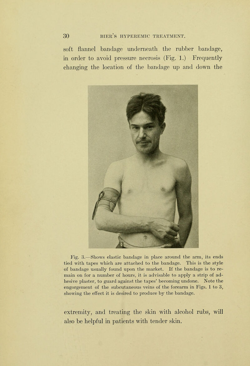 soft flannel bandage underneath the rubber bandage, in order to avoid pressure necrosis (Fig. 1.) Frequently changing the location of the bandage up and down the Fig. 3.—Shows elastic bandage in place around the arm, its ends tied with tapes which are attached to the bandage. This is the style of bandage usually found upon the market. If the bandage is to re- main on for a number of hours, it is advisable to apply a strip of ad- hesive plaster, to guard against the tapes' becoming undone. Note the engorgement of the subcutaneous veins of the forearm in Figs. 1 to 3, showing the effect it is desired to produce by the bandage. extremity, and treating the skin with alcohol rubs, will also be helpful in patients with tender skin.