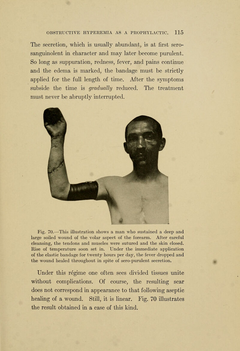 The secretion, which is usually abundant, is at first sero- sanguinolent in character and may later become purulent. So long as suppuration, redness, fever, and pains continue and the edema is marked, the bandage must be strictly applied for the full length of time. After the symptoms subside the time is gradually reduced. The treatment must never be abruptly interrupted. Fig. 70.—This illustration shows a man who sustained a deep and large soiled wound of the volar aspect of the forearm. After careful cleansing, the tendons and muscles were sutured and the skin closed. Rise of temperature soon set in. Under the immediate application of the elastic bandage for twenty hours per day, the fever dropped and the wound healed throughout in spite of sero-purulent secretion. Under this regime one often sees divided tissues unite without complications. Of course, the resulting scar does not correspond in appearance to that following aseptic healing of a wound. Still, it is linear. Fig. 70 illustrates the result obtained in a case of this kind.